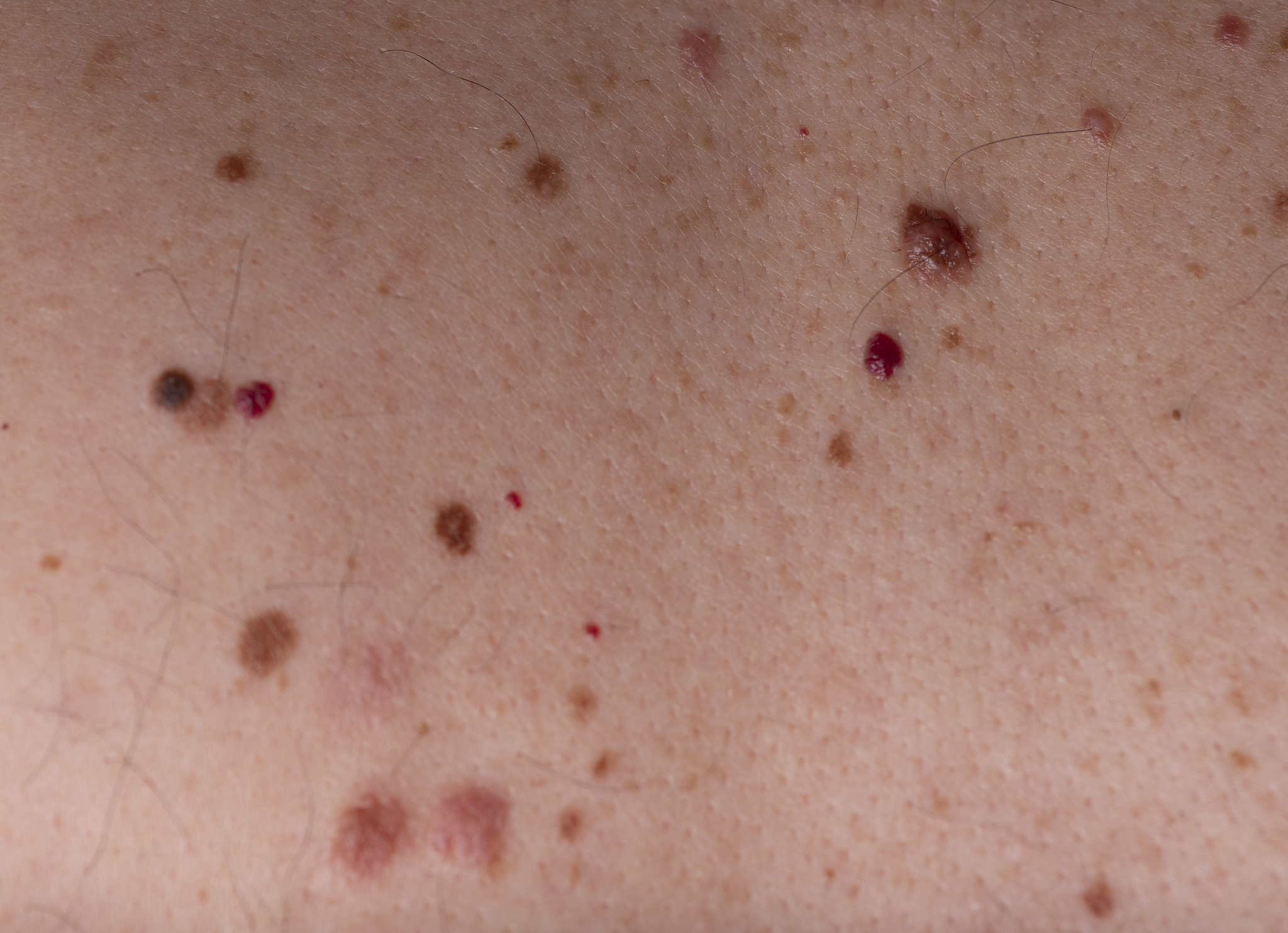 背上痣的含义：迷信与科学解读