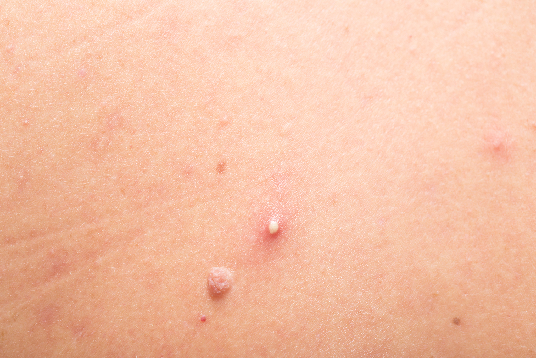 mole and pimple