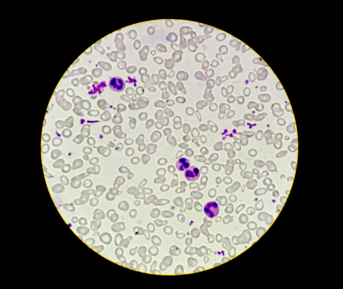 医学检验中血液细胞检验的质量控制影响因素