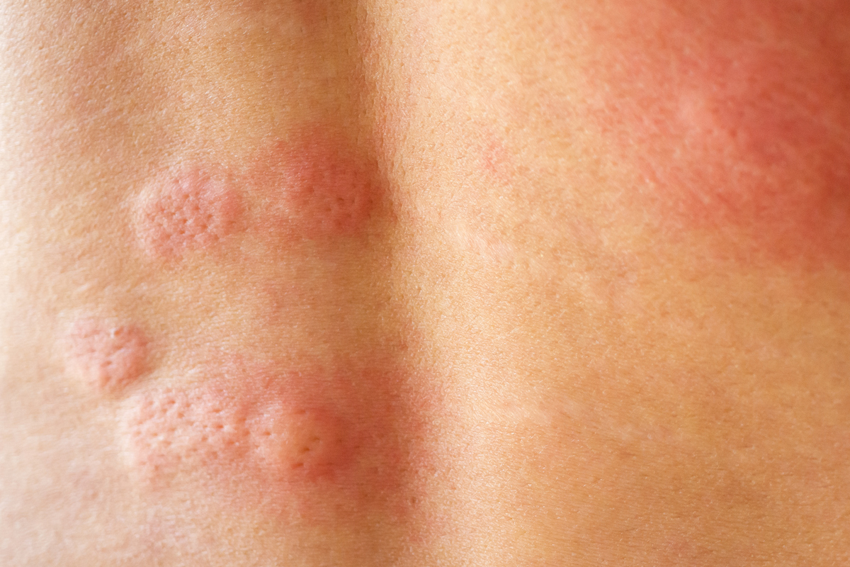 脸上长普通红癣怎么版