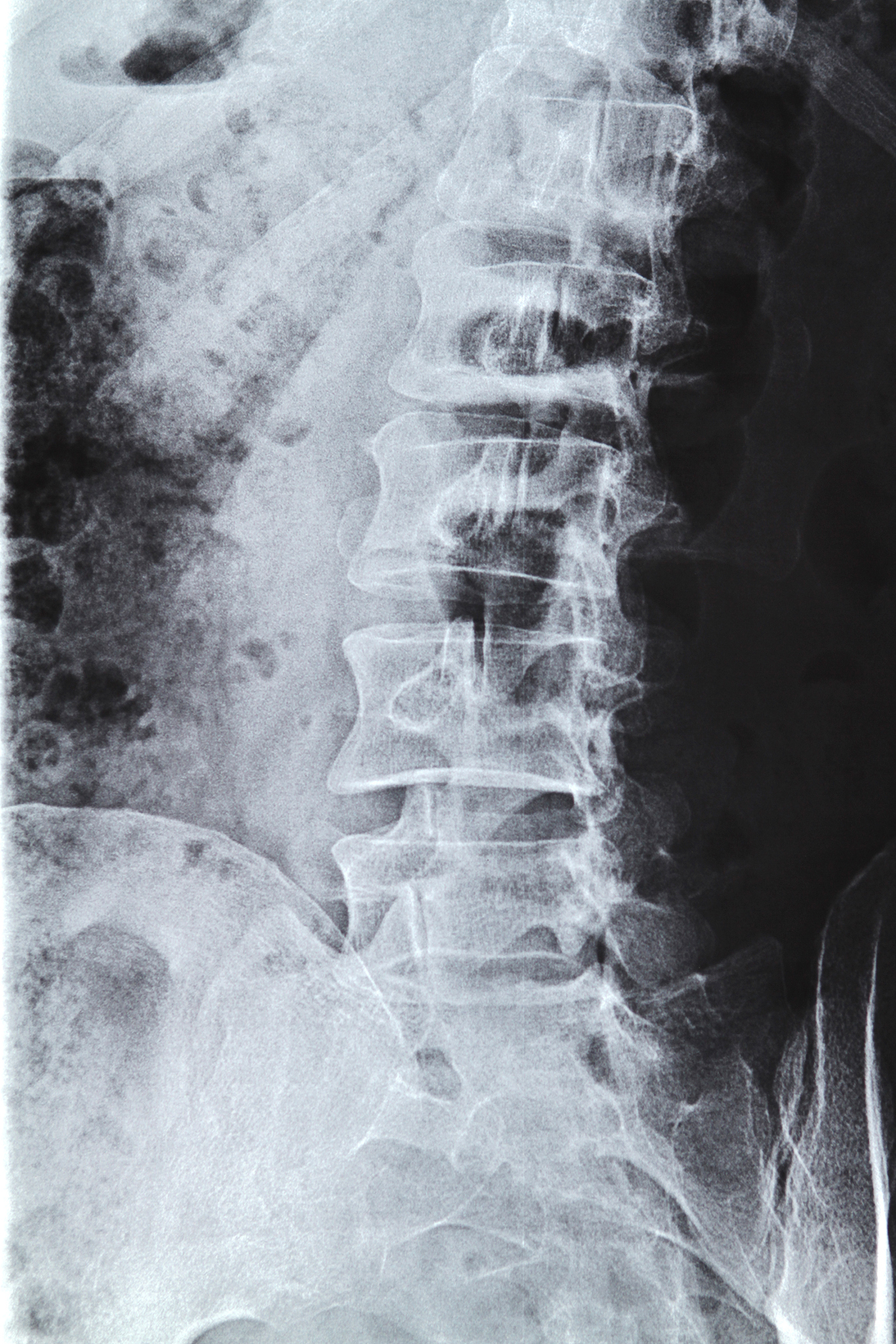 椎体成形术（PVP）：治疗背部疼痛的有效方法