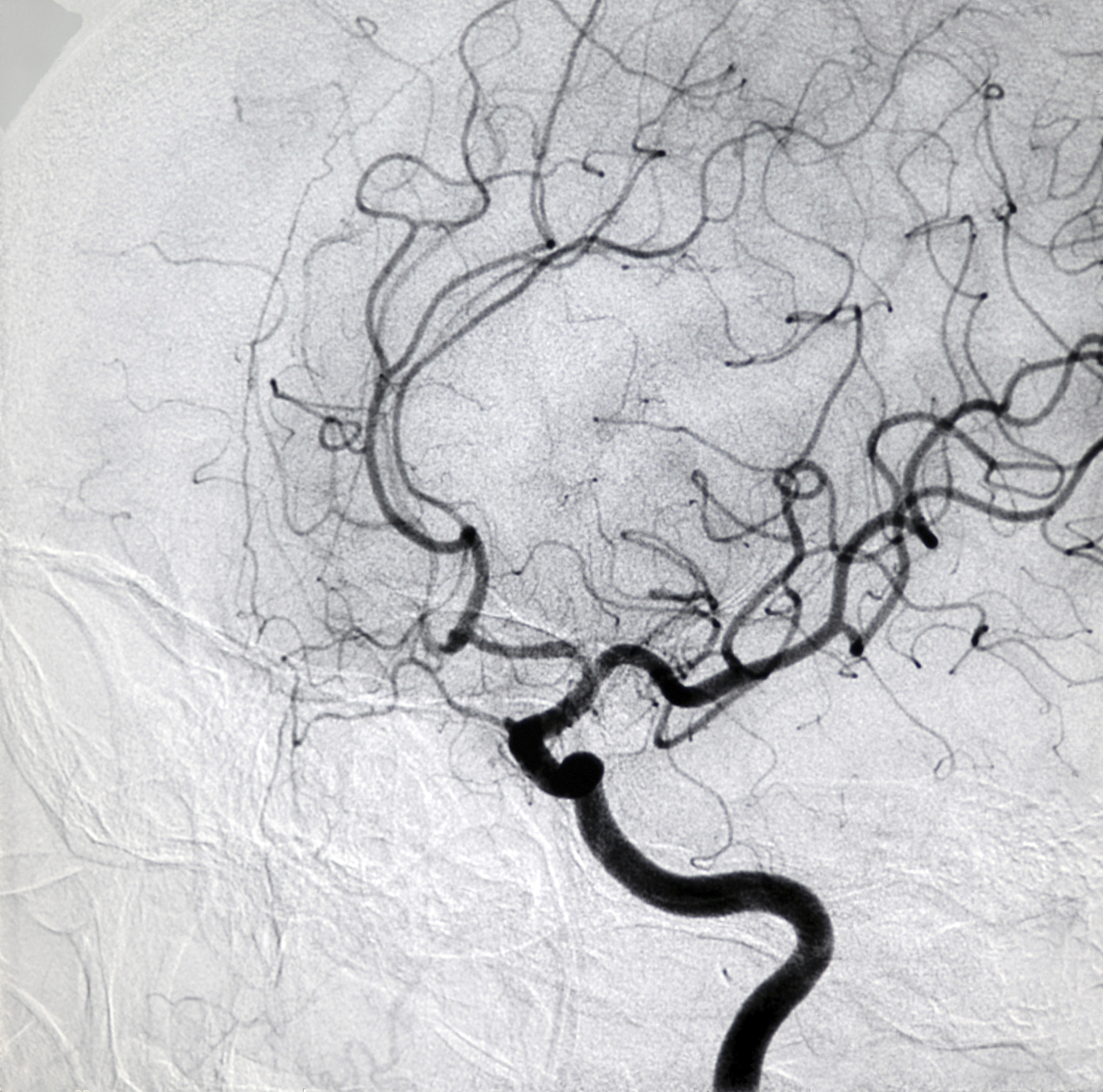 右侧颈动脉易损性斑块破裂形成溃疡，伴随自由漂浮血栓及中度狭窄