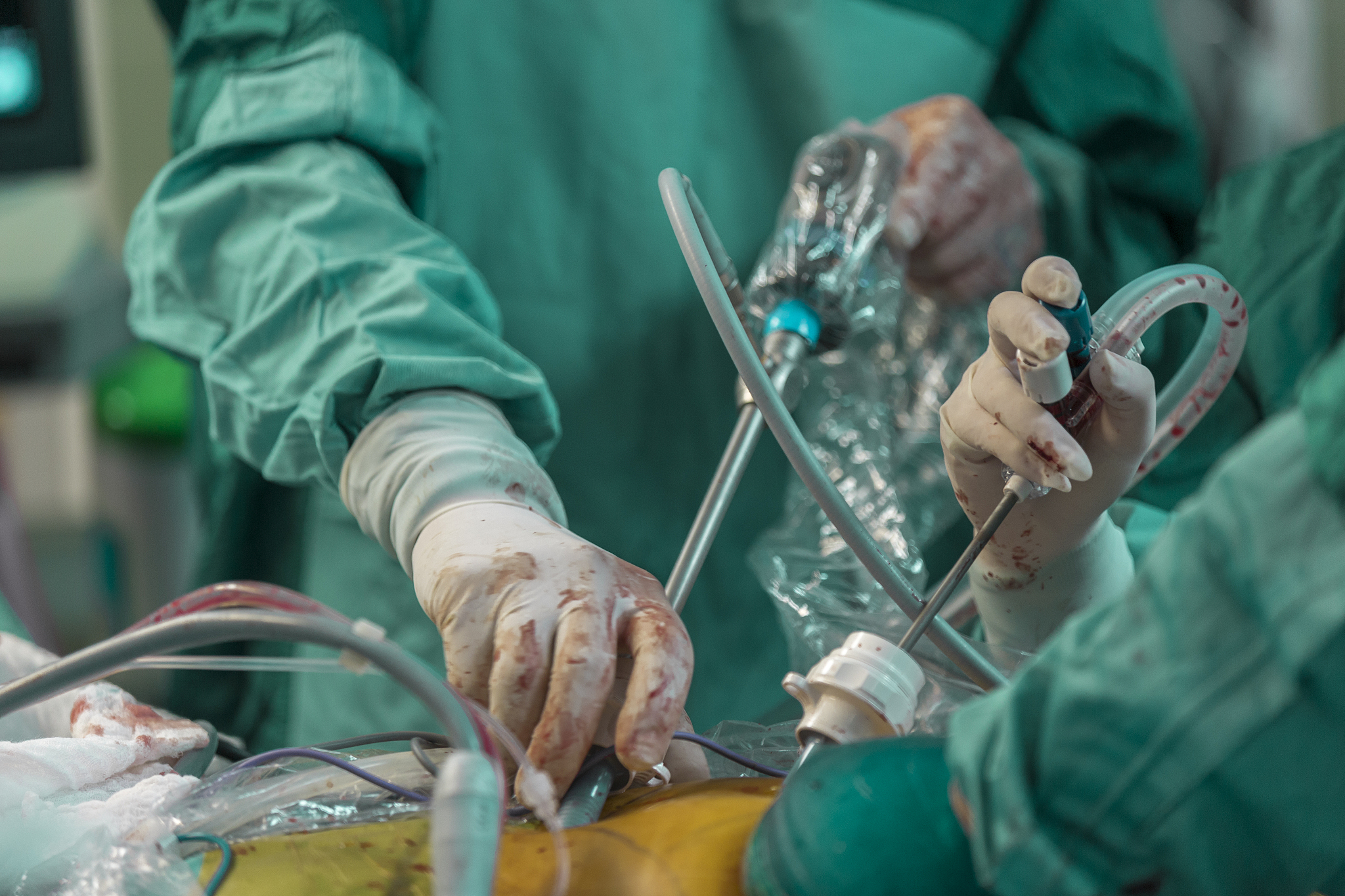 laparoscopic surgery.surgeons operating with laparoscope