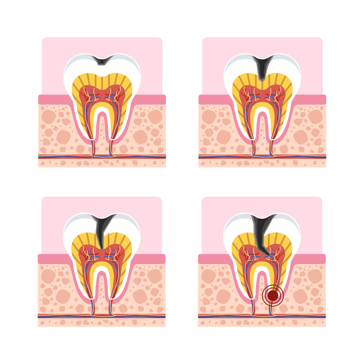 蛀牙的治疗方式