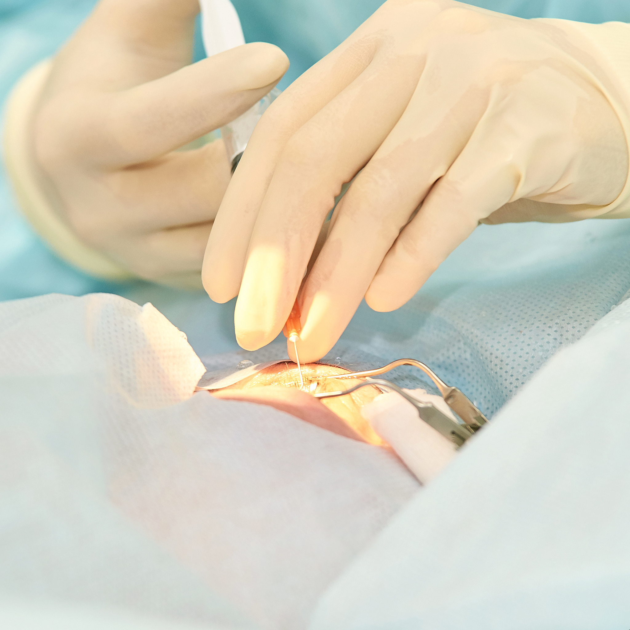 治疗近视飞秒激光和晶体植入哪个划算晶体植入是不是得不偿失