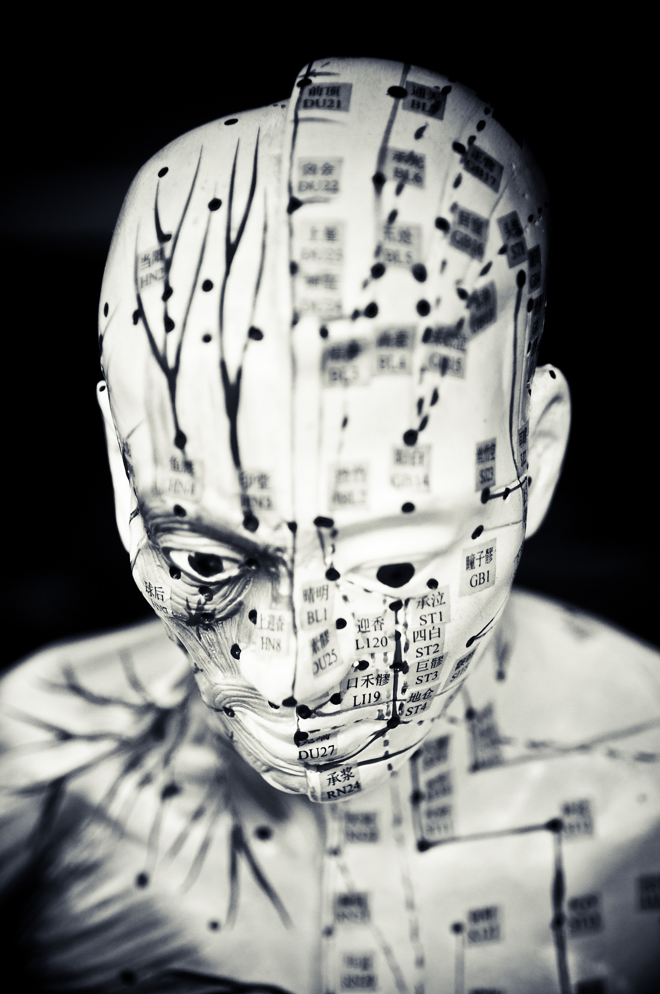 acupuncture