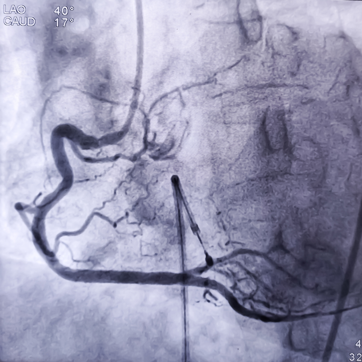 冠心病手术治疗：方法、适用人群及风险