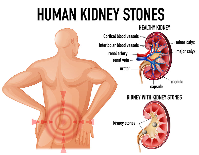 前立腺がん：男性で2番目に多いがん、肥満との関係は不明 - WHO