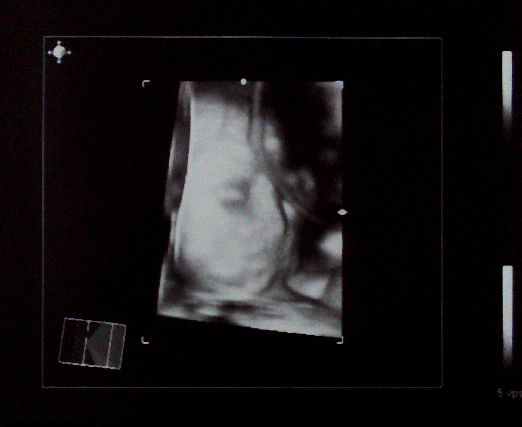 四维羊水最大深度807mm