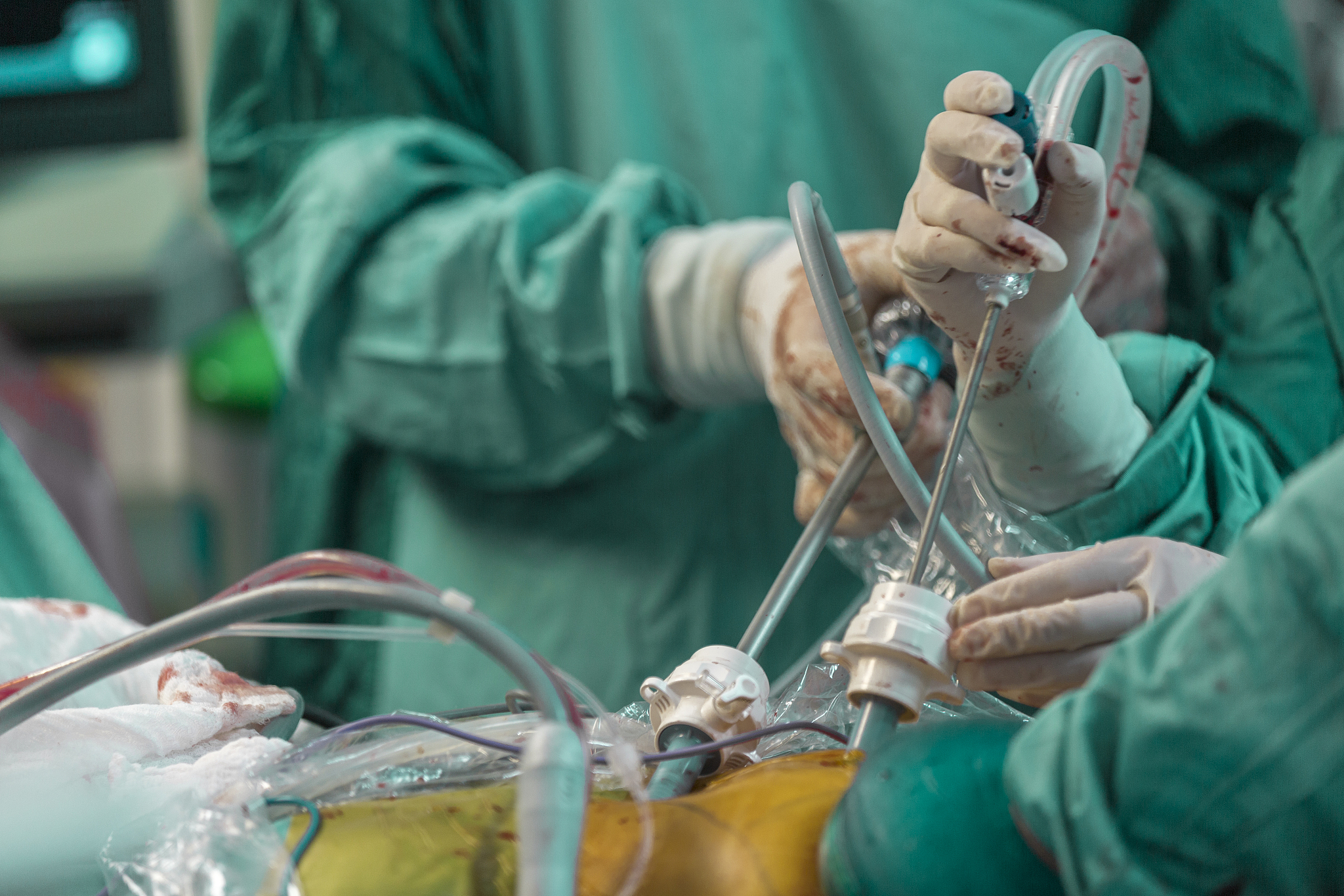 laparoscopic surgery.surgeons operating with laparoscope