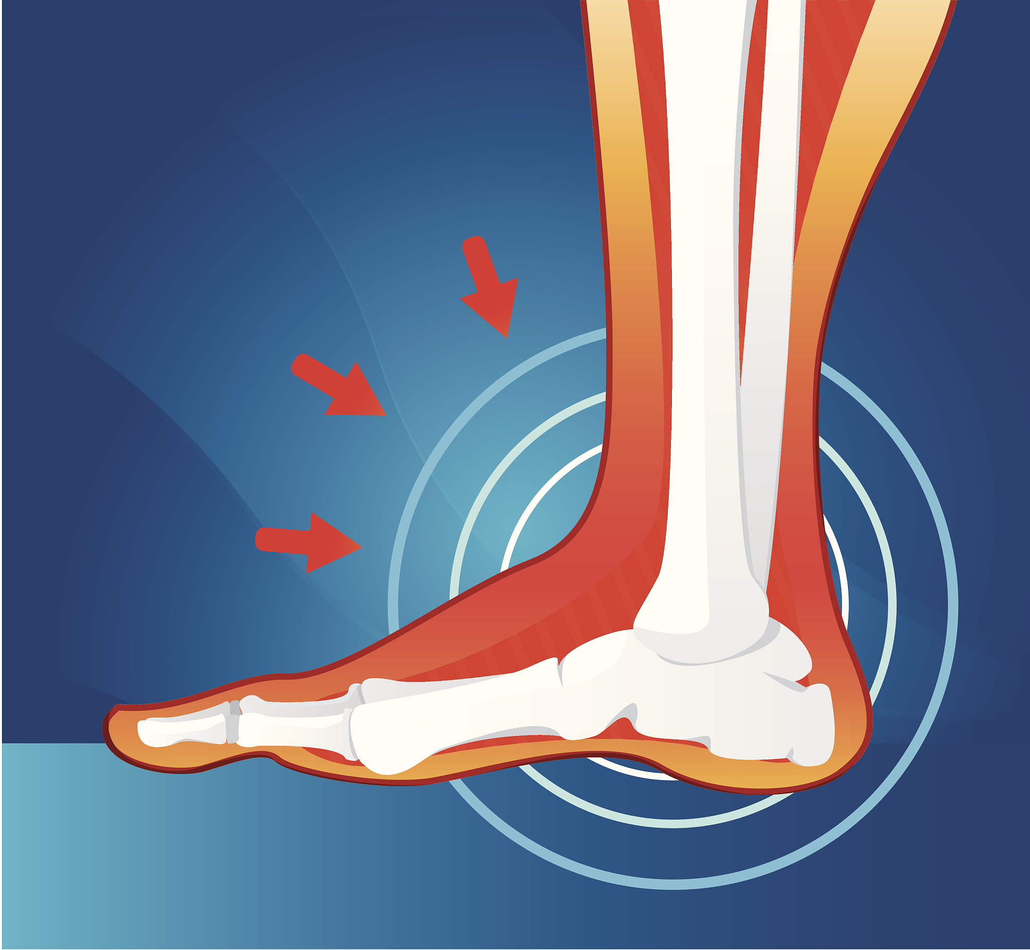 足部运动损伤治疗研究进展：从足底筋膜炎到踝关节扭伤