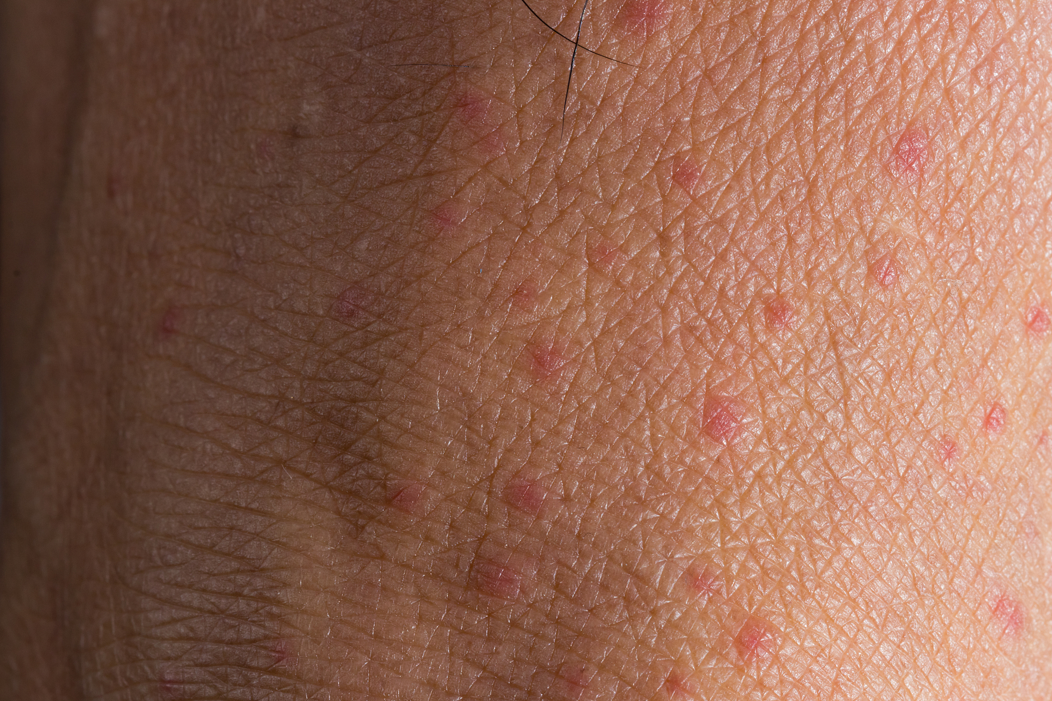 many of mosquito bites sore and scar