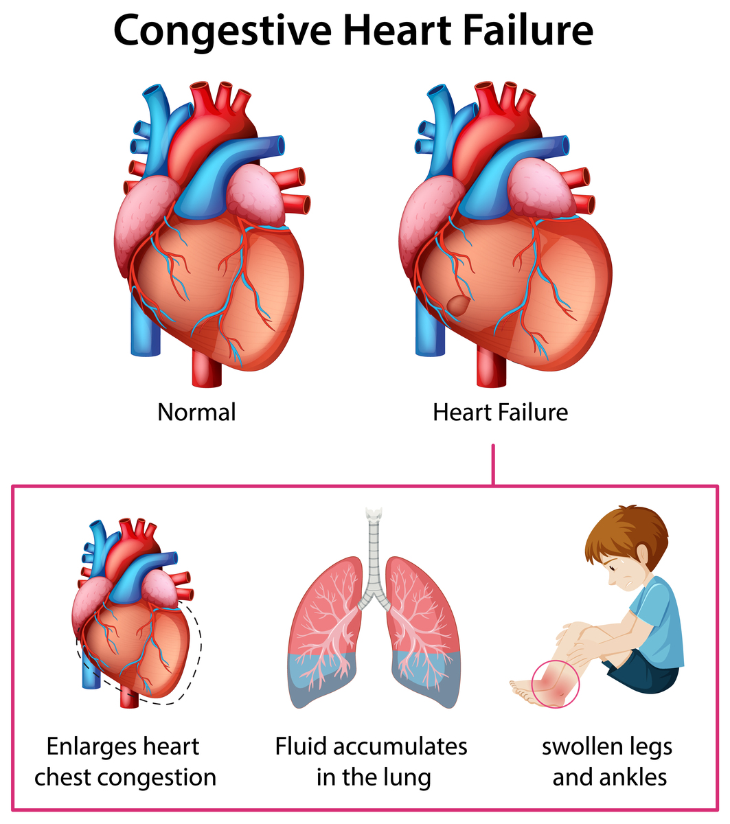 心衰伴心包积液患者呼吸护理指南 - 改善呼吸困难，提高生活质量