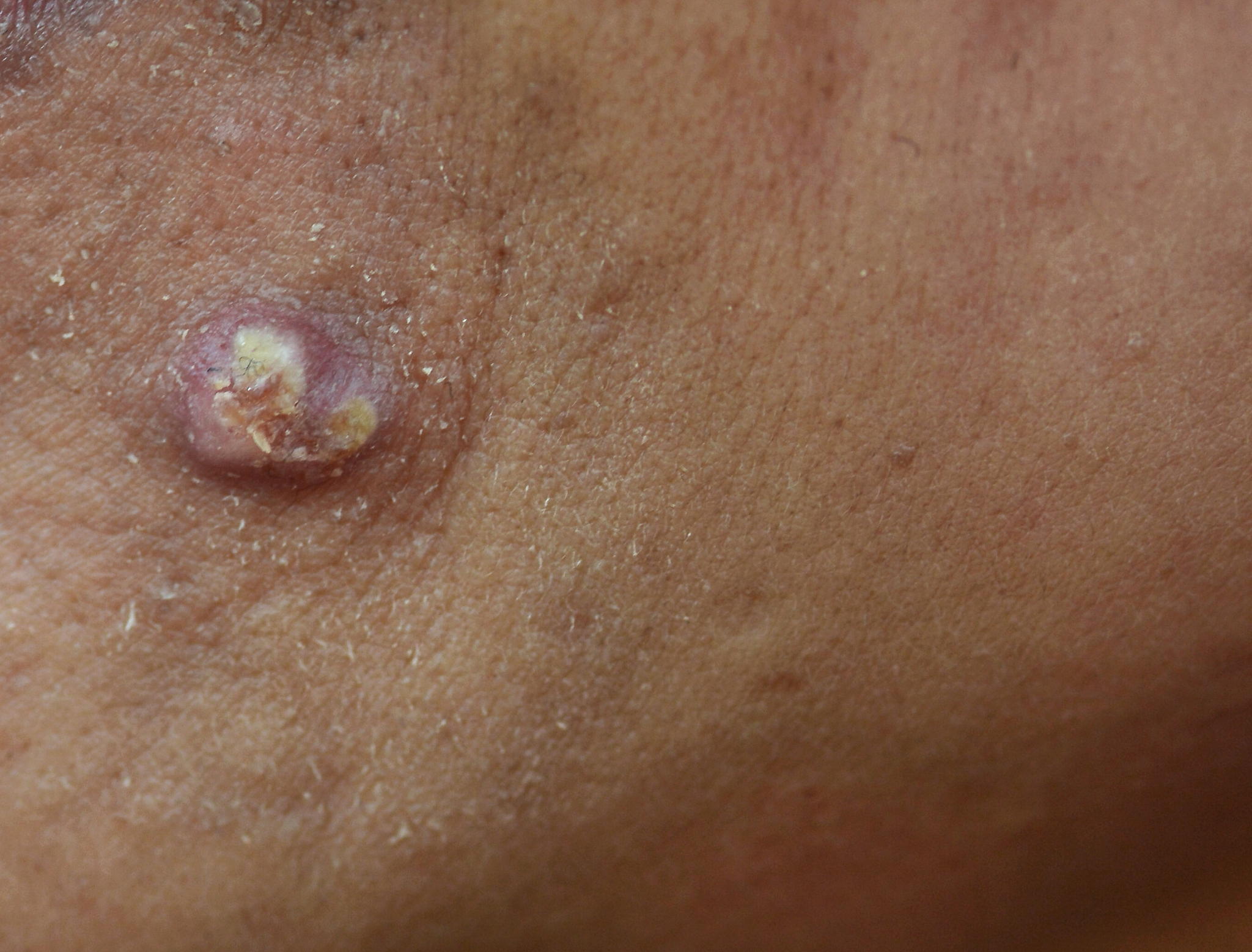 acne on skin face
