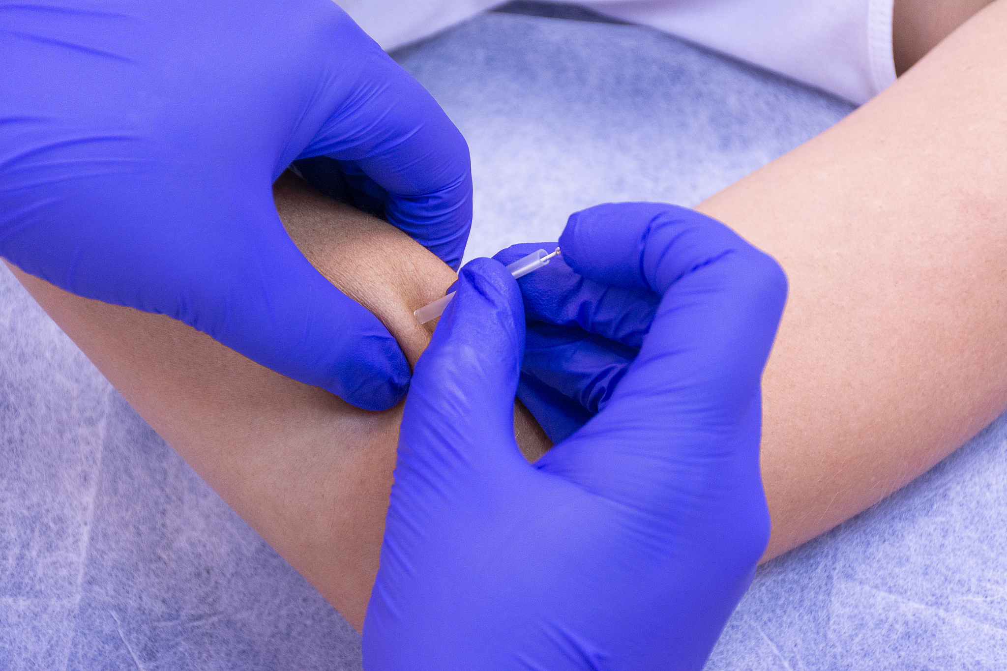nailing an acupuncture needle
