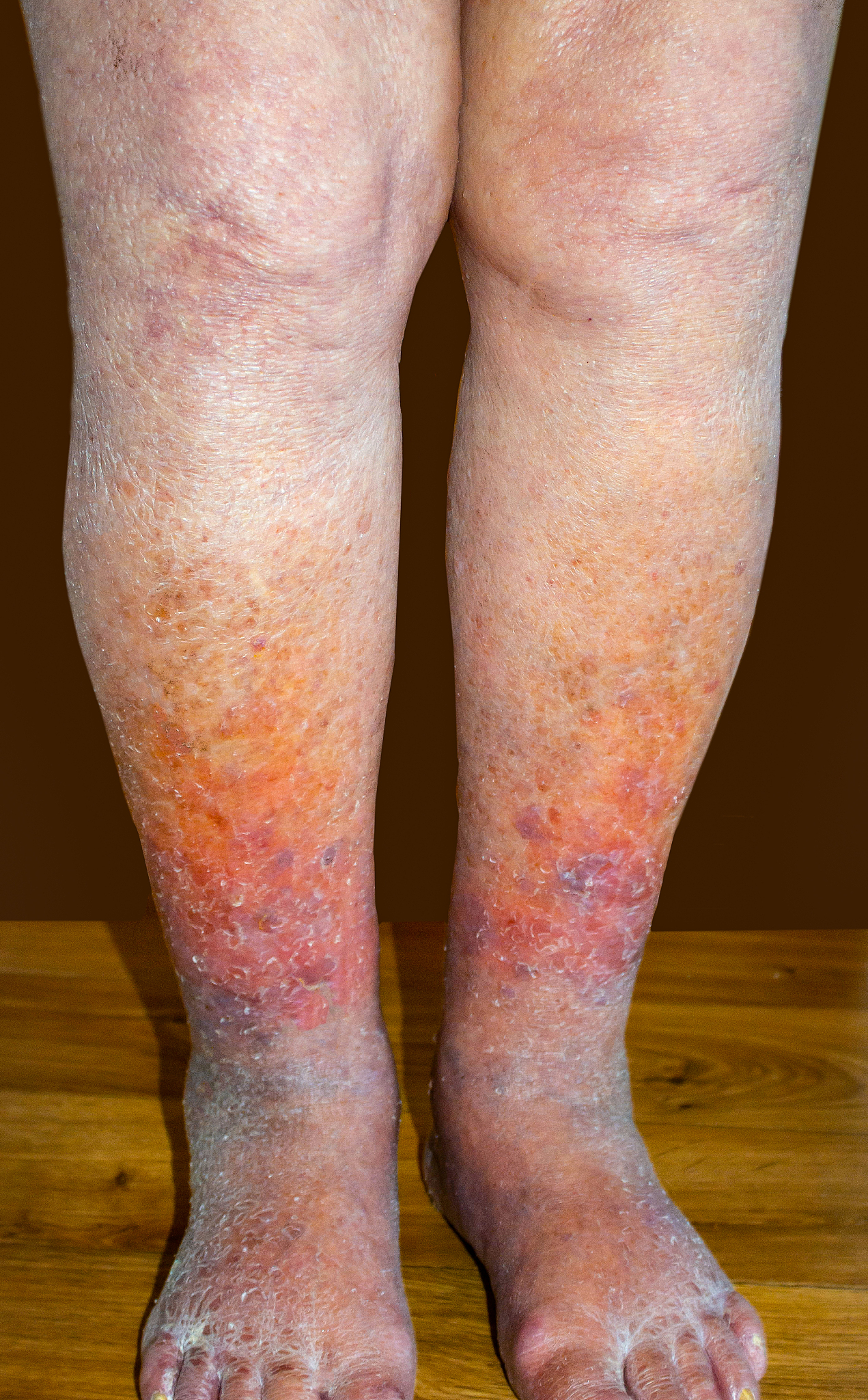 将以下内容洗稿静脉曲张不手术会怎么样？一般来说呢静脉曲张它是一个不算大的毛病所以呢即使不立刻手术一般不会导致截肢或者残疾等等非常严重的后果包括皮肤皮疹包括色素沉着但是呢在静脉曲张的并发症期它会导致各种其他的症状包括最后的皮肤溃烂甚至呢可能由静脉曲张导致深静脉血栓形成那么如果出现了深静脉血栓甚至有危及生命的可能性因此在小毛病的时候它也有可能导致大毛病所以我们还是建议病人在发现静脉曲张之后早期到医院里