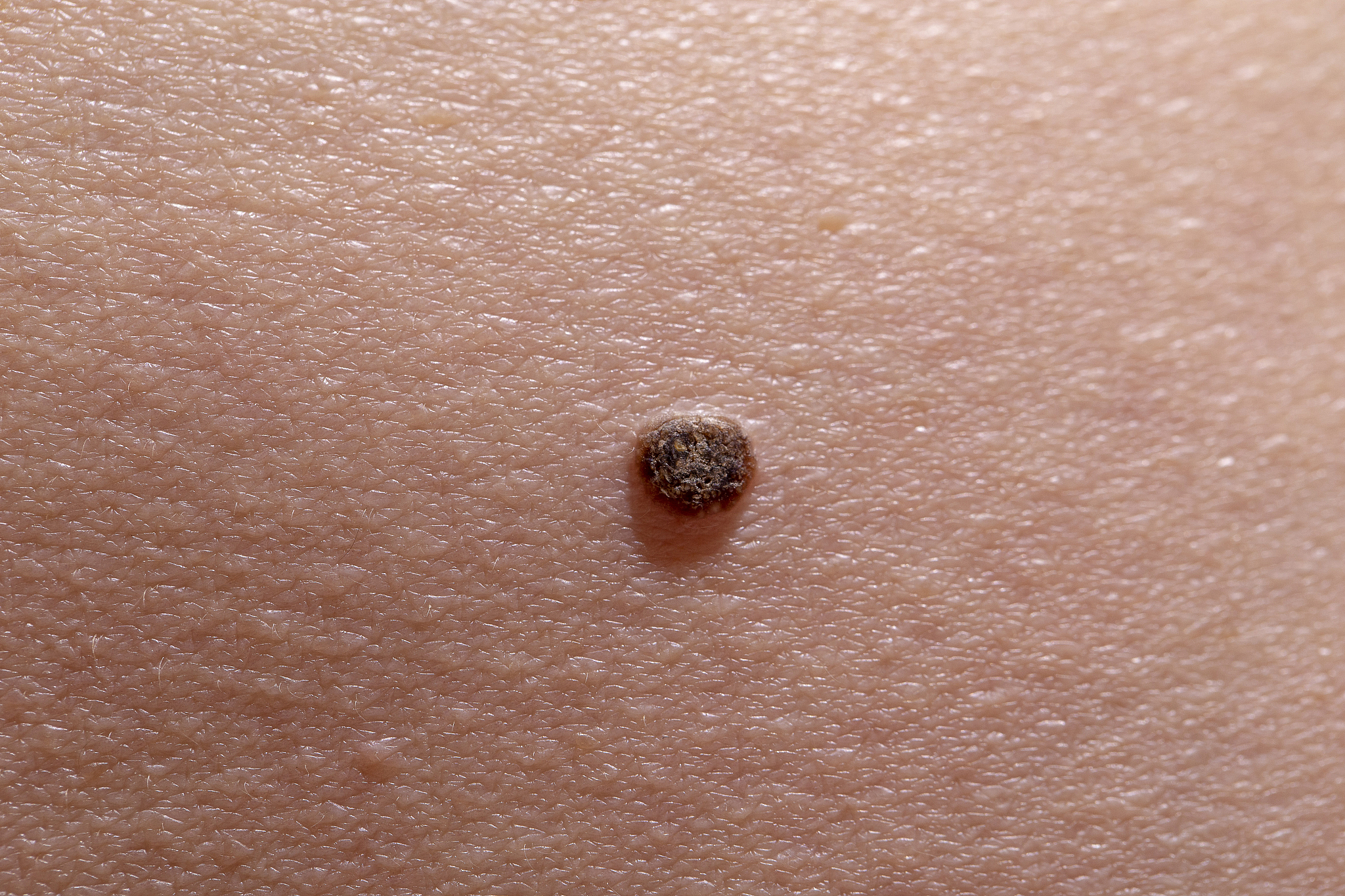 the initial stage of melanoma
