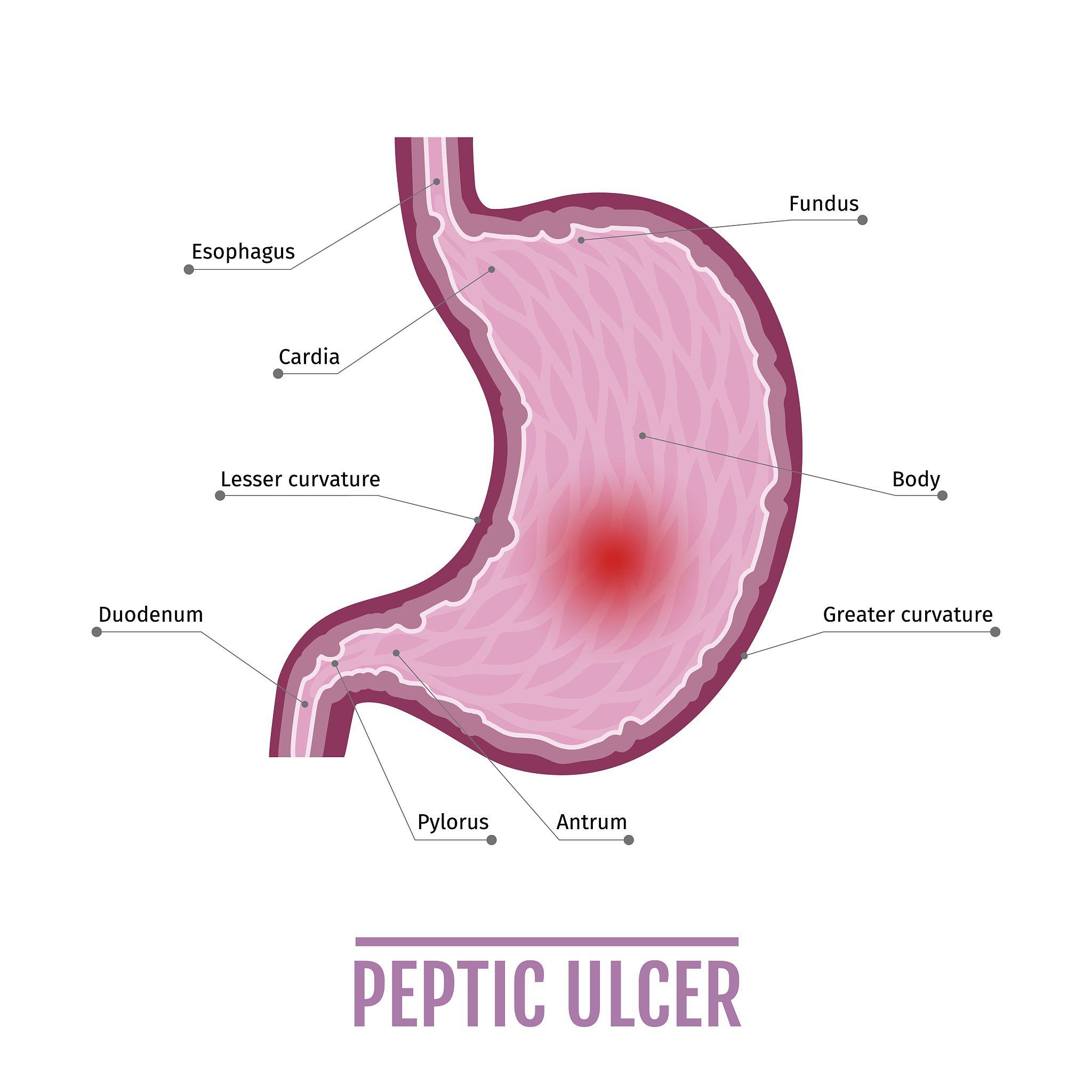 粘连性肠梗阻解痉的重要性