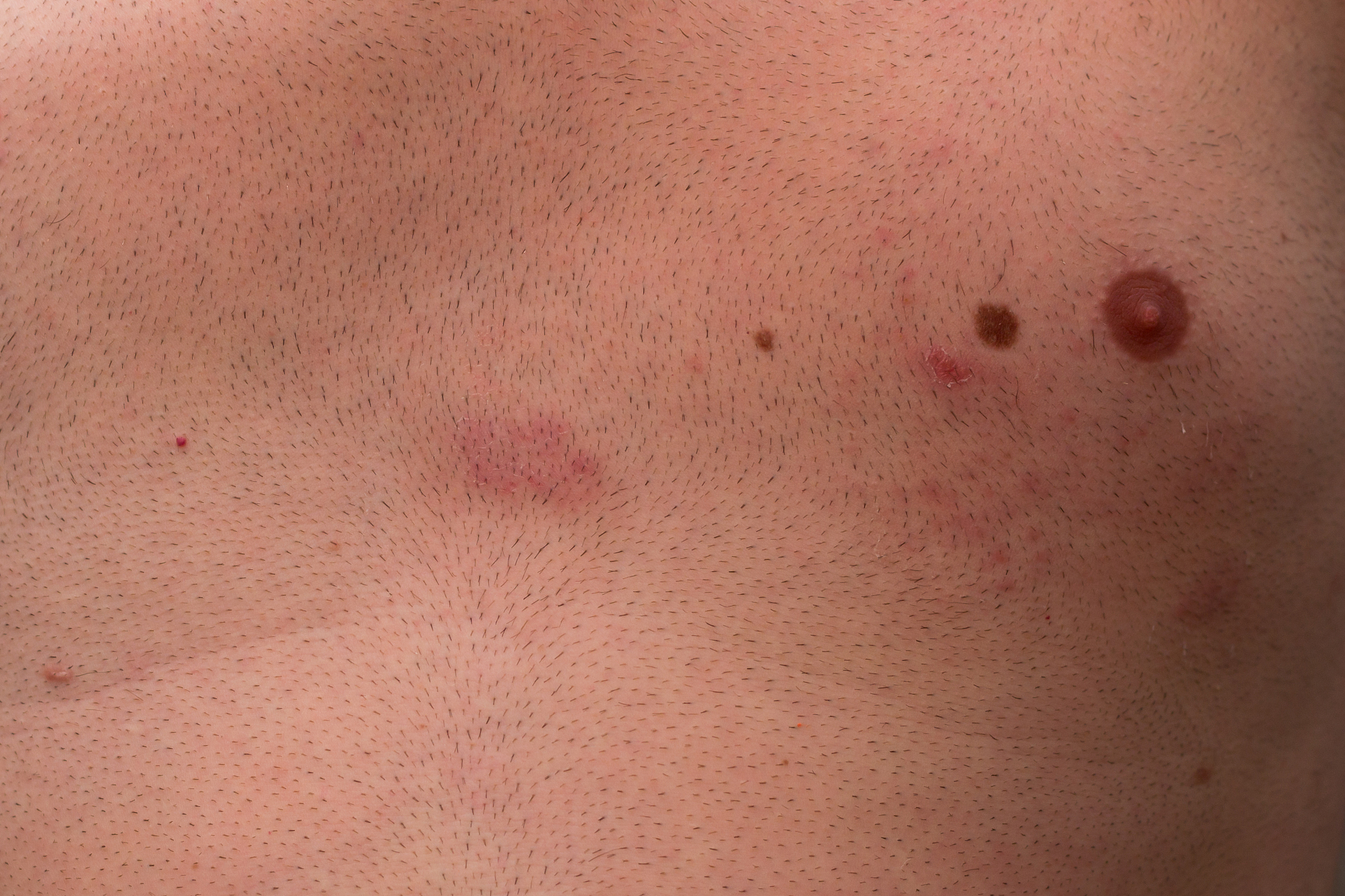 zona zoster infection