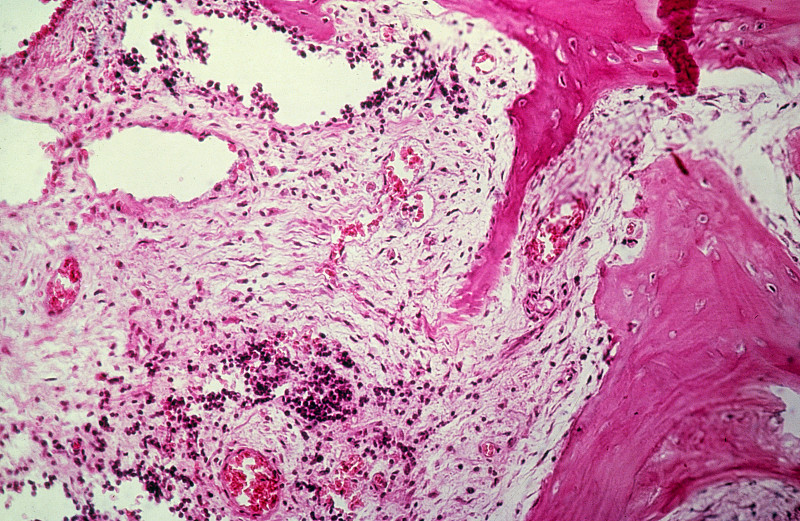 食用红肉容易患哪些癌症