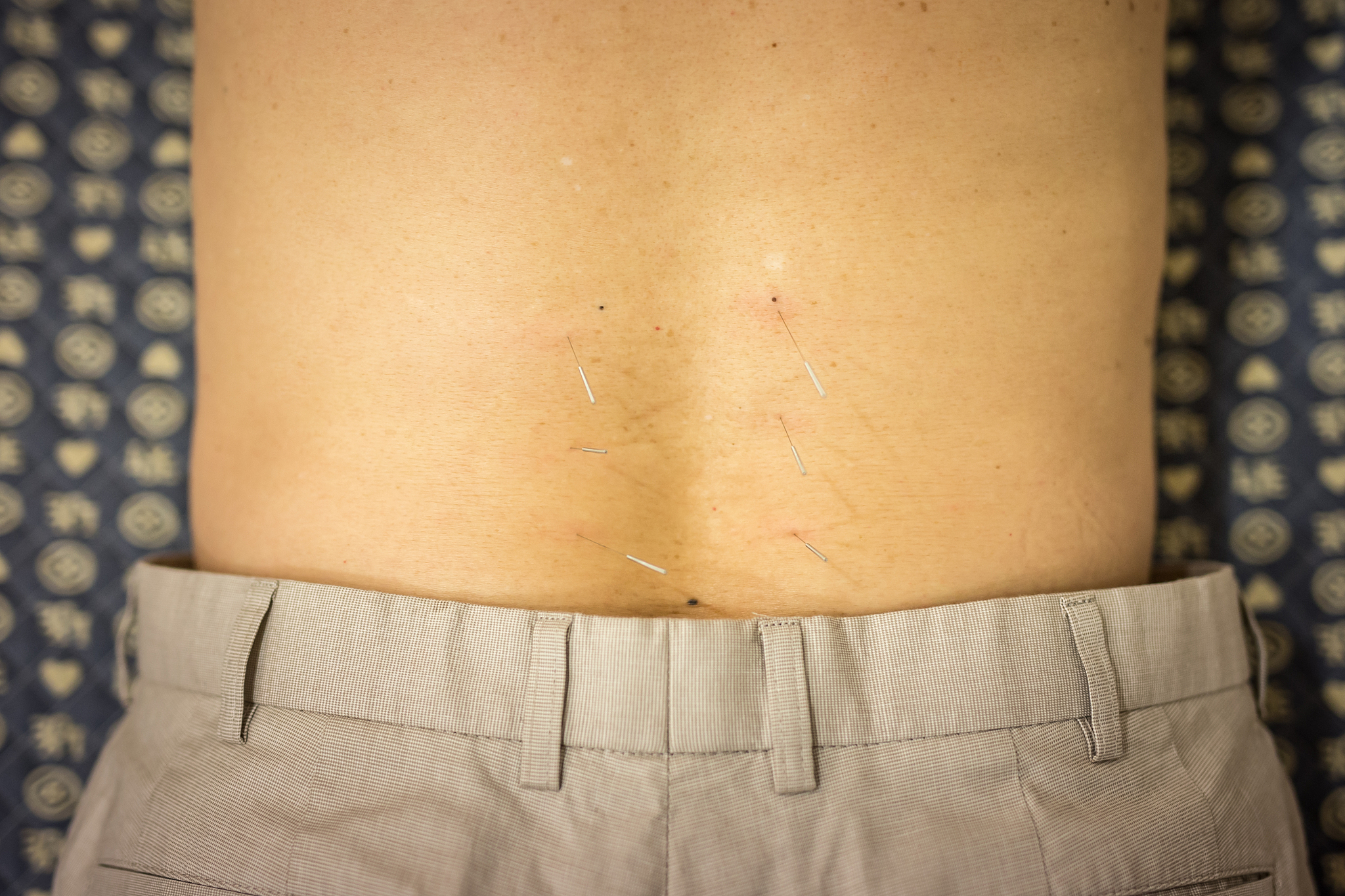acupuncture treatment