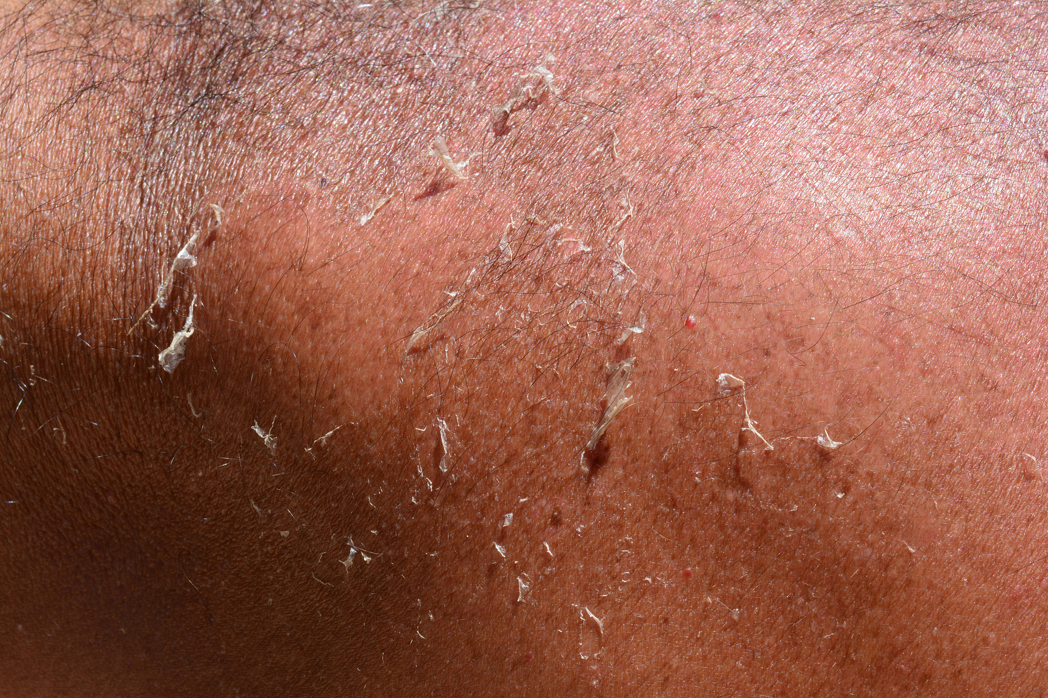 tanned human skin with sunburns, close up