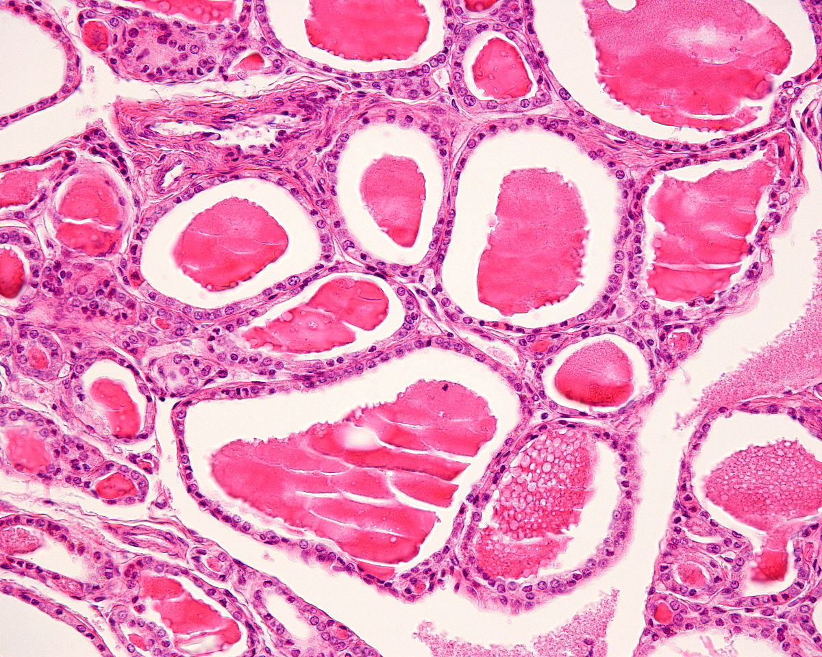 翻译：FSGS病变最早见于皮髓交界处且呈局灶节段性分布因而容易误诊、漏诊。因此强调肾组织活检取材应包括皮髓交界组织。
