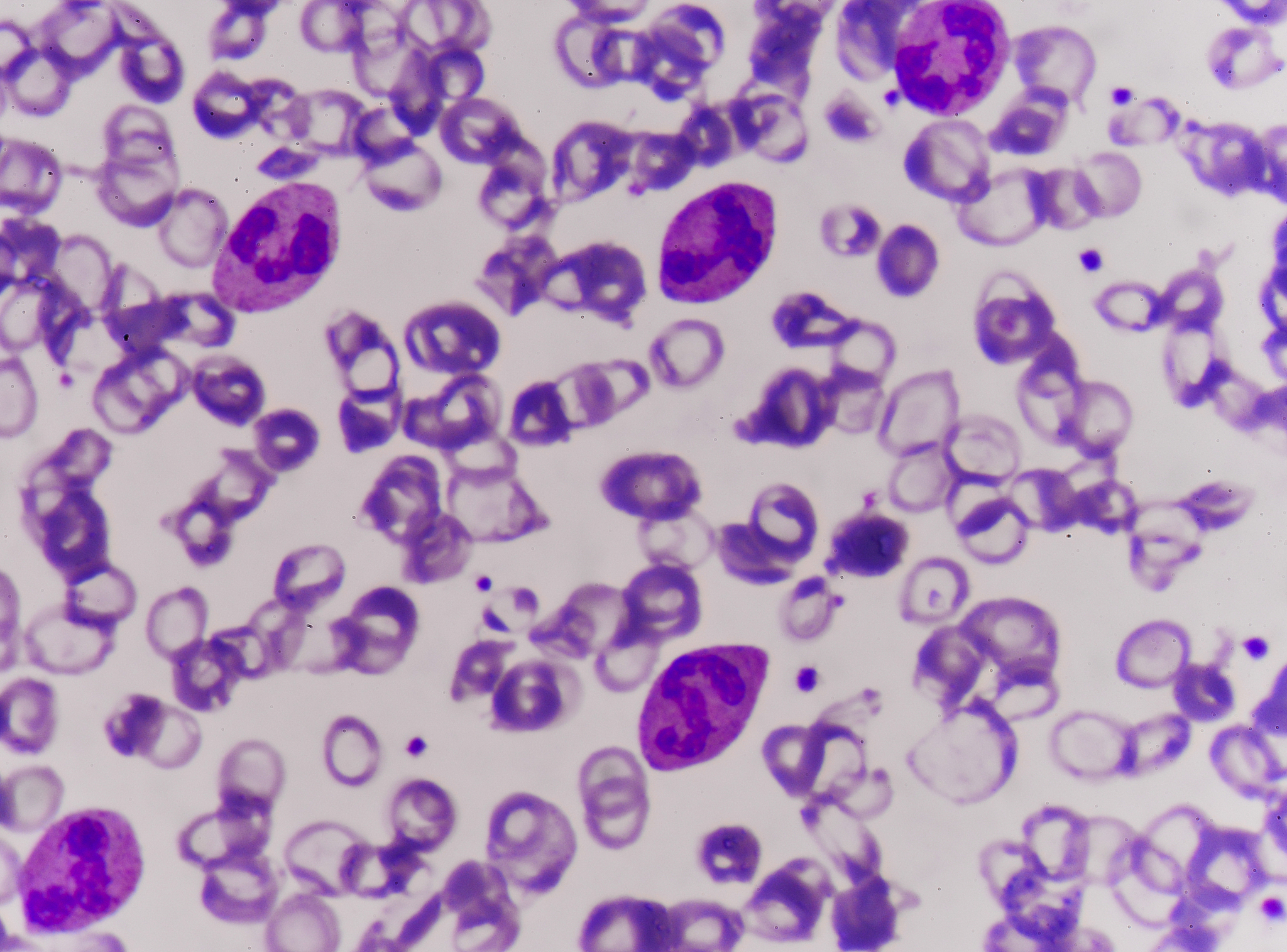 通过血常规怎么判断是细菌感染还是病毒感染