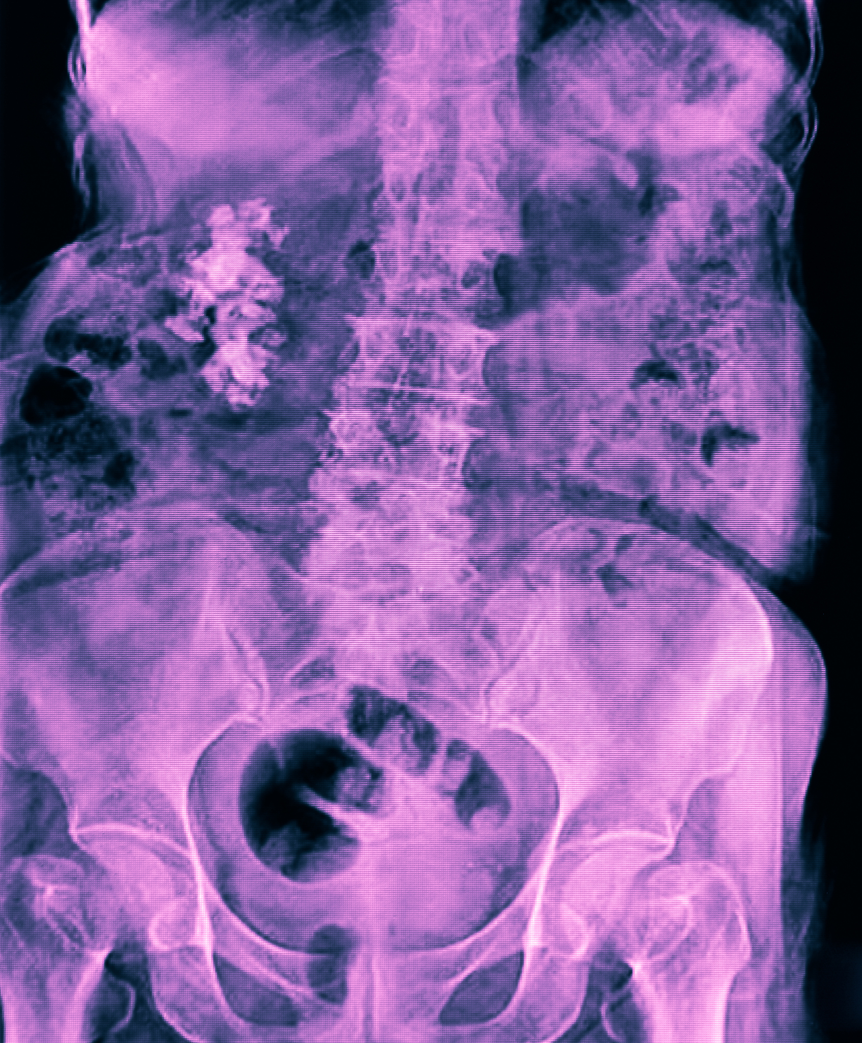 尿酸与肾结石的关系是什么？