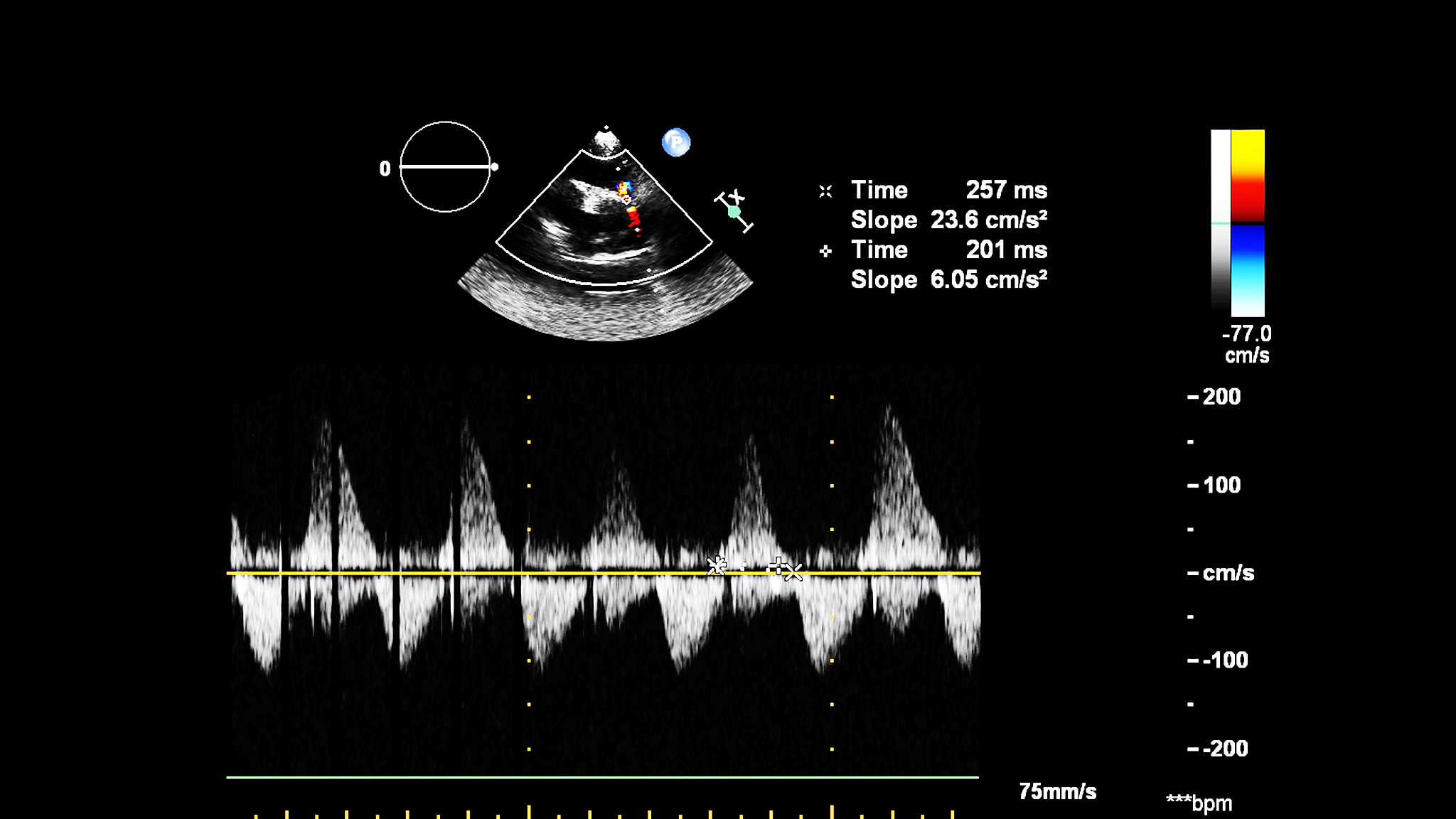 逆散射问题中的非线性与噪声：初始猜测误导和局部解