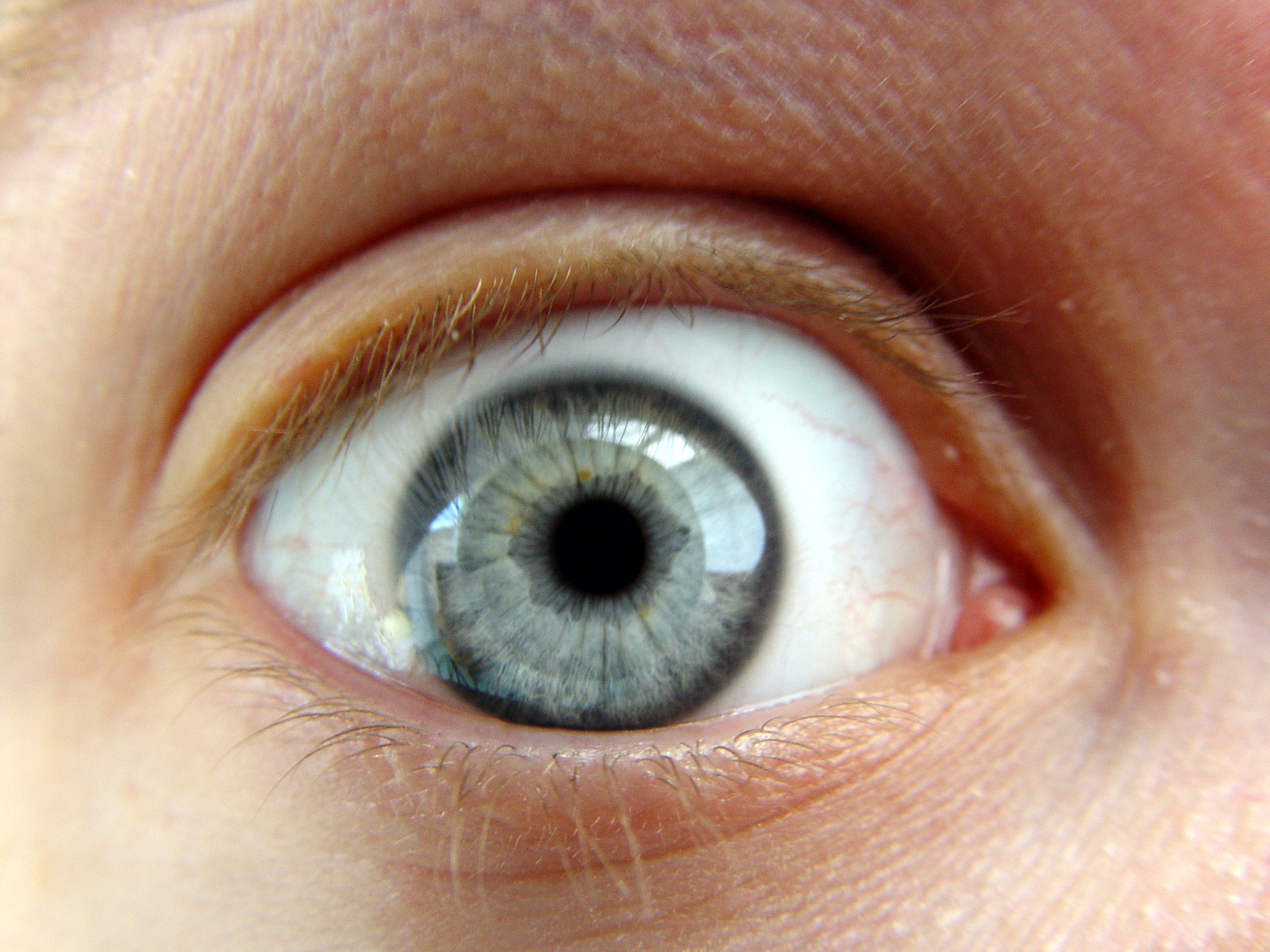 真菌性角膜炎的临床特征中关于眼部不适感的具体说明