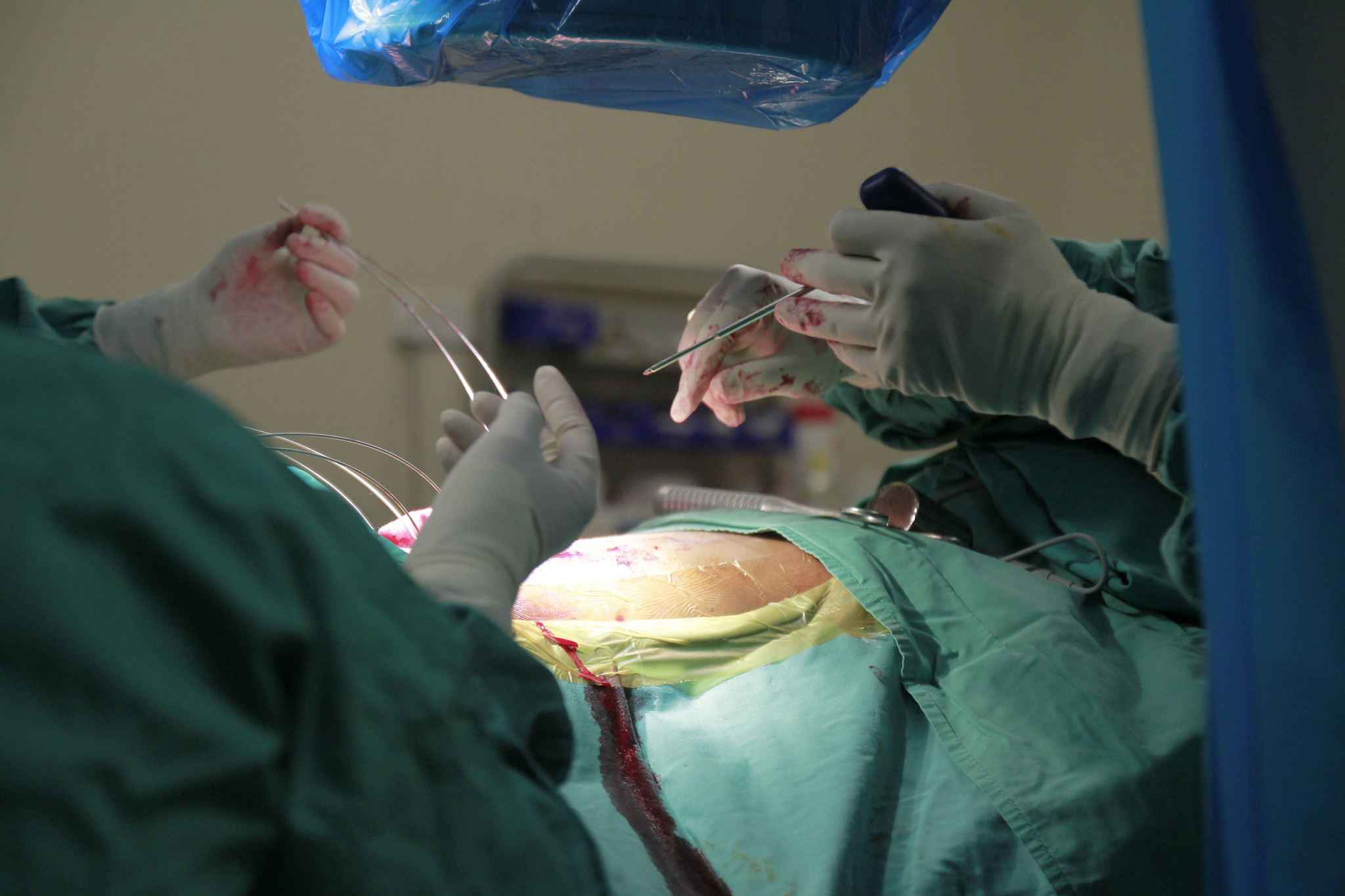 midsection of surgeons operating patient at hospital