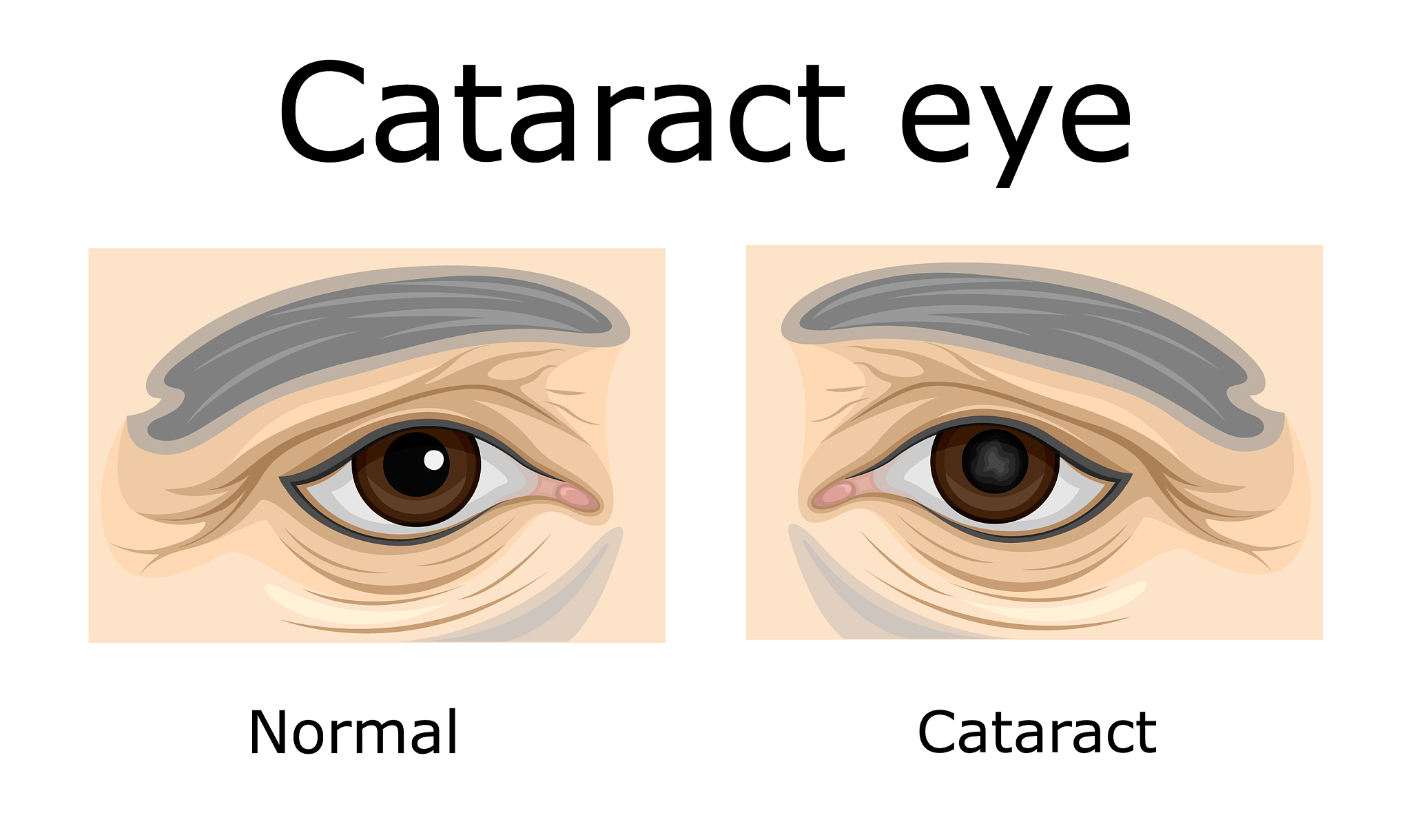 66爱眼日：科普白内障，‘睛’彩视界有保障 | 直播活动方案