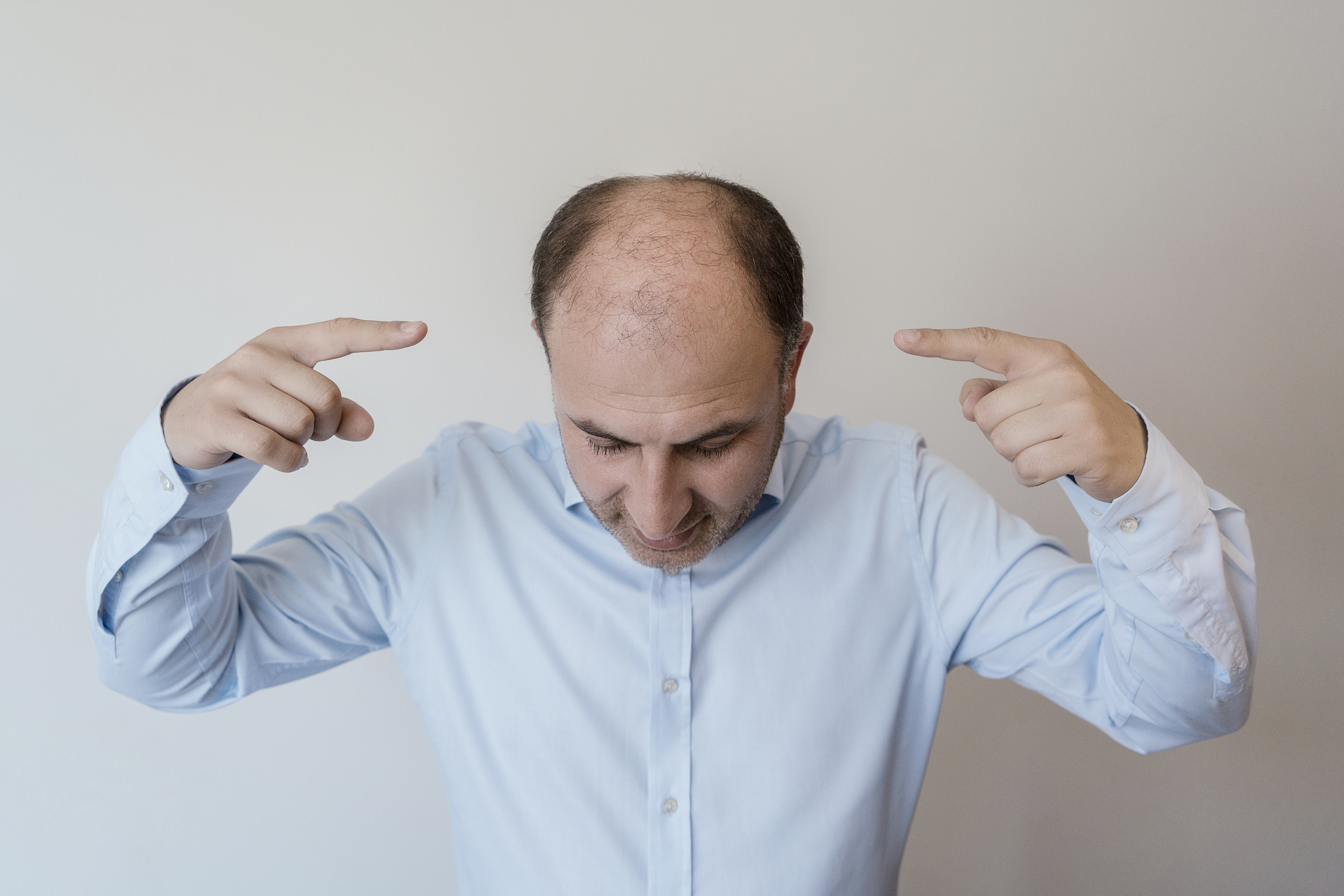 balding