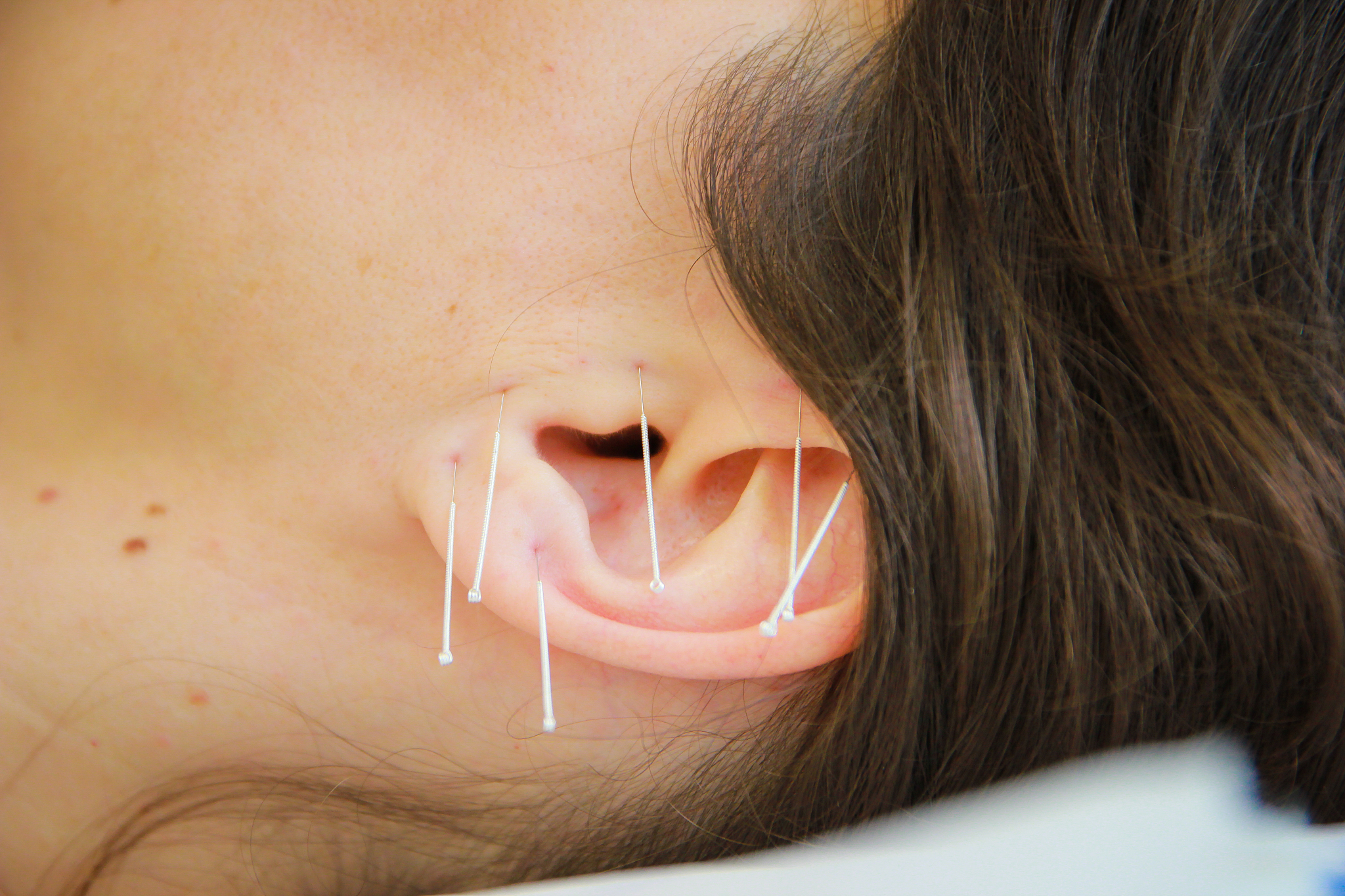 close-up of woman with acupuncture needles on ear