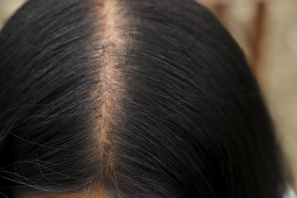 揪头发秃顶怎么办？可能是拔毛症！