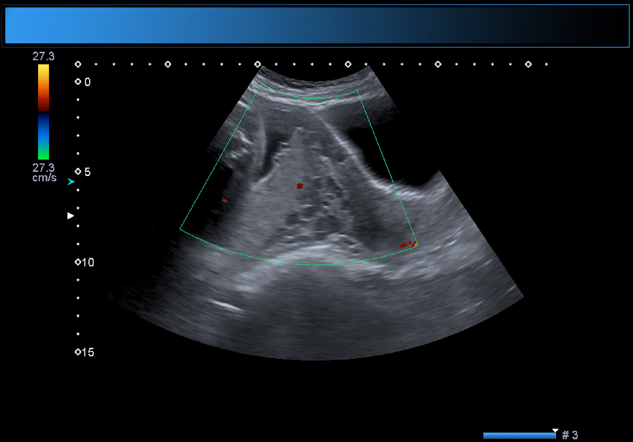 哺乳期妇女可以吃布洛芬吗？