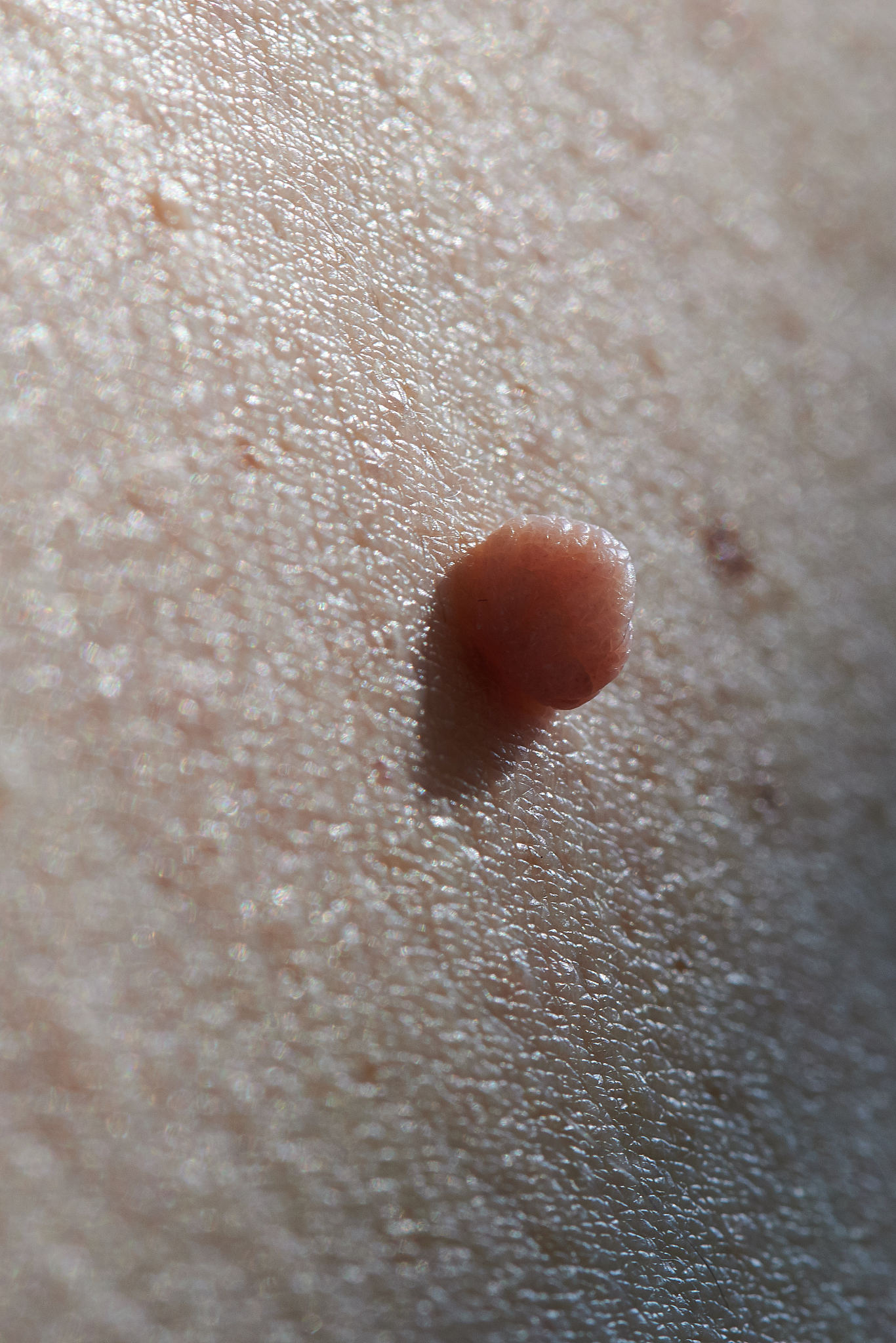 manifestation of the disease human papilloma virus is a neoplasm
