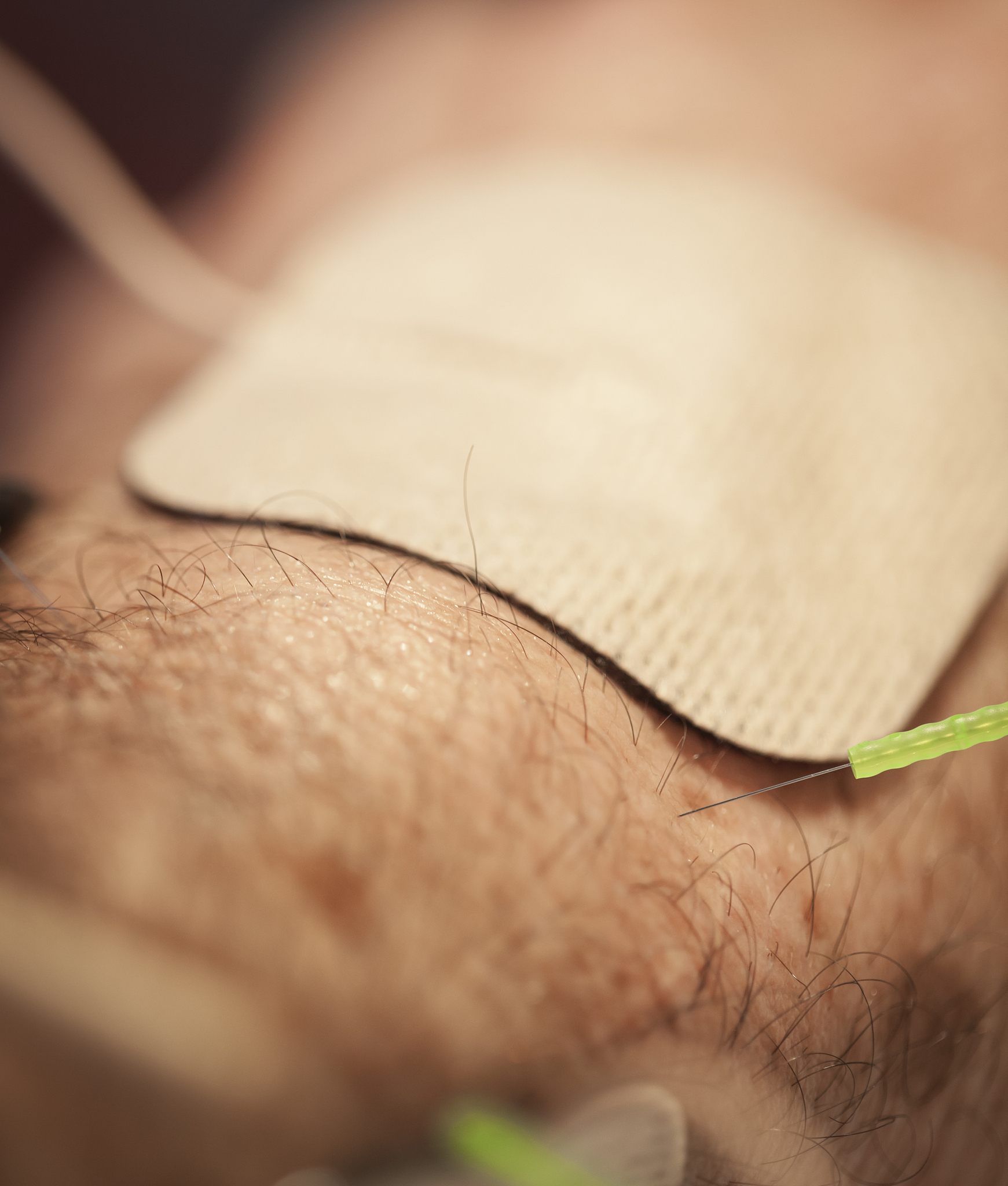 我要写一篇关于合谷刺针灸疗法的写选穴规律需要在PubMed上找全英文文章请问应该如何检索文献请告诉我具体的检索式和检索方法