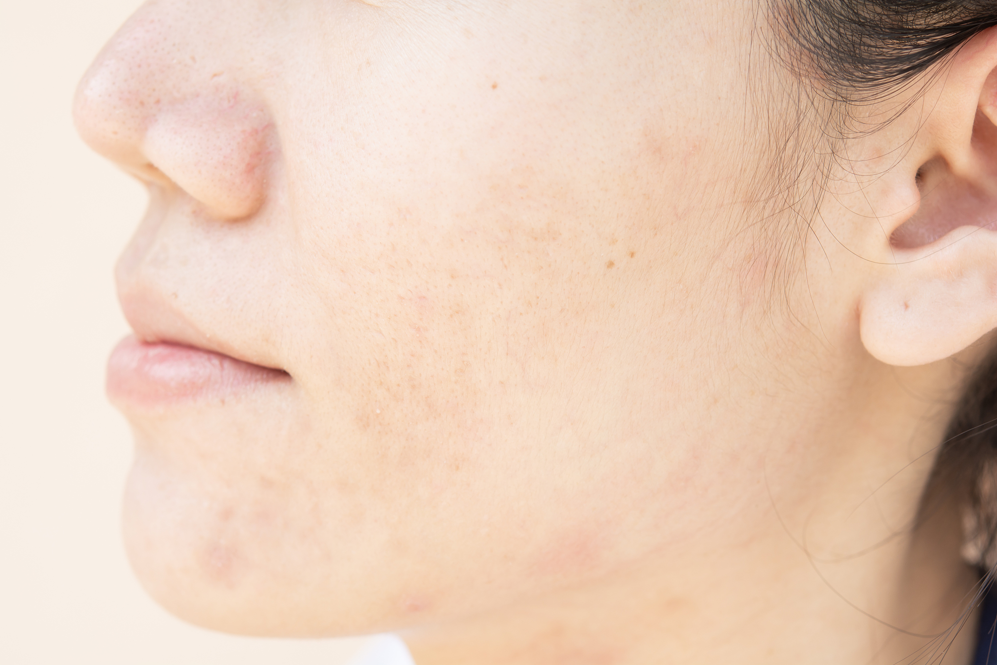 dark spots and scar from acne
