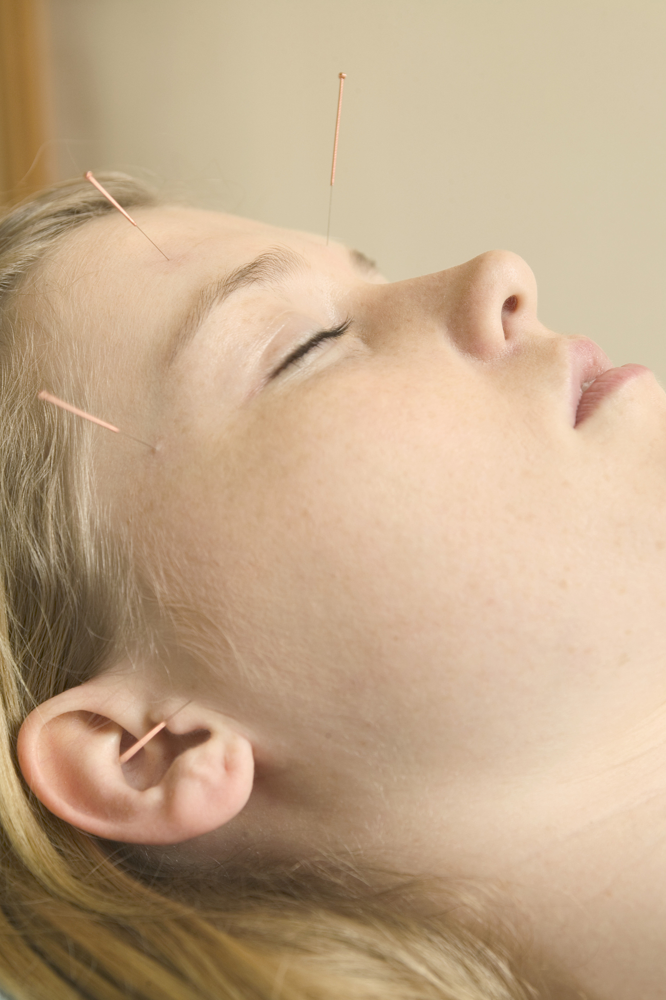 young woman with acupuncture needles on face, close-up