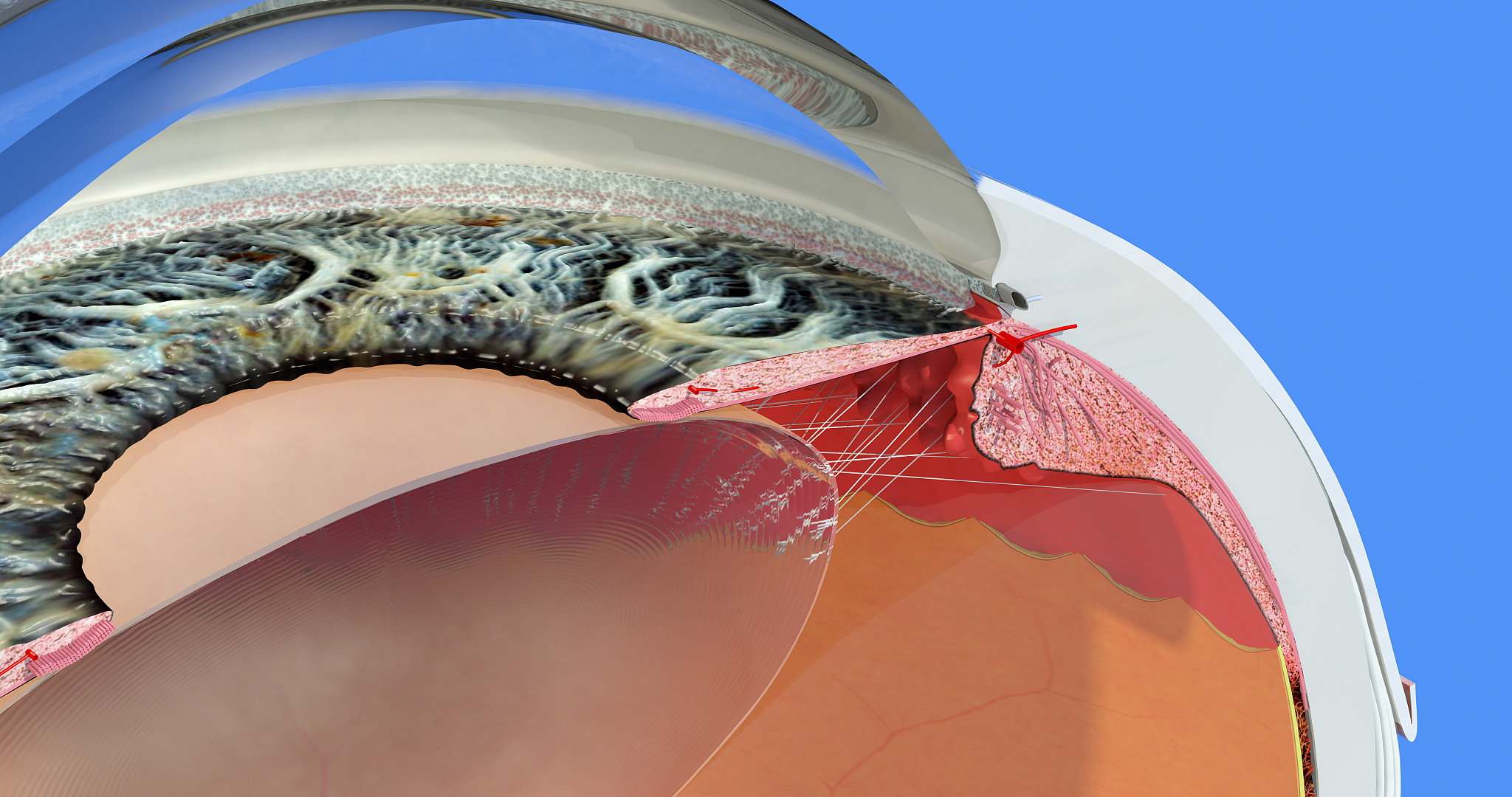 微小切口角膜基质透镜取出术后饮食指南：促进眼部恢复的关键