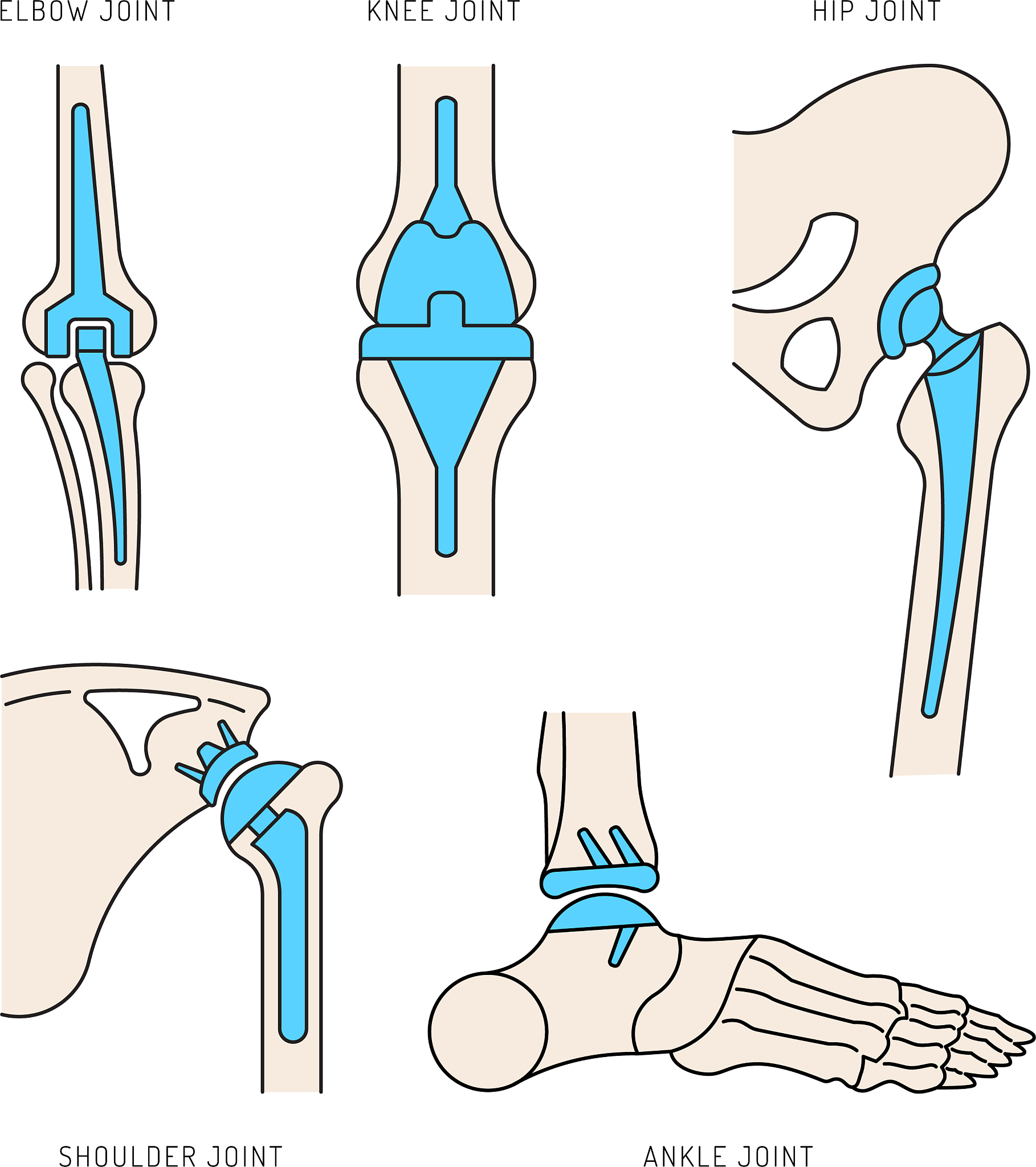 Broström 术：修复距腓前韧带和跟腓韧带损伤的有效方法