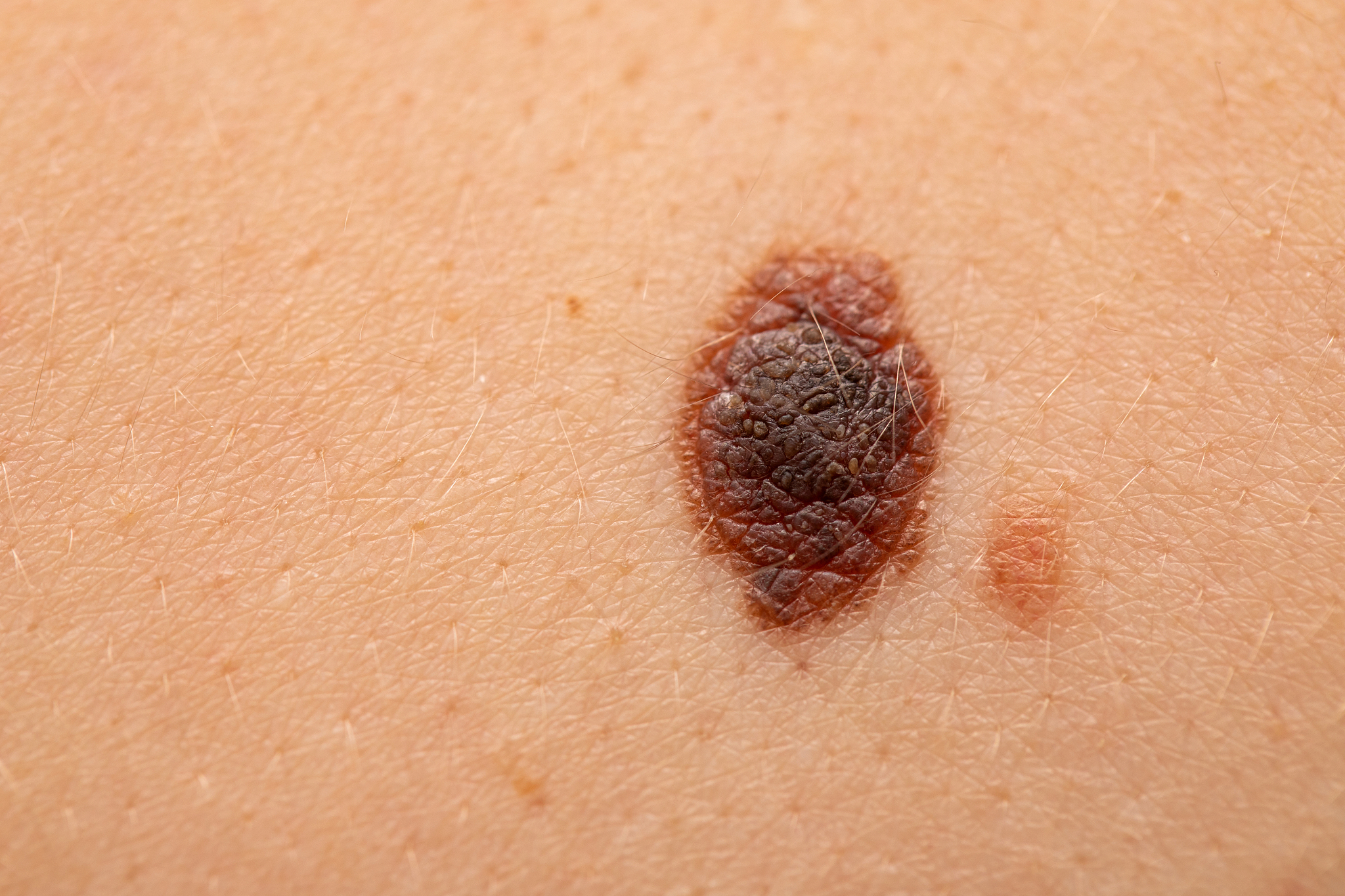 dangerous nevus on skin - melanoma