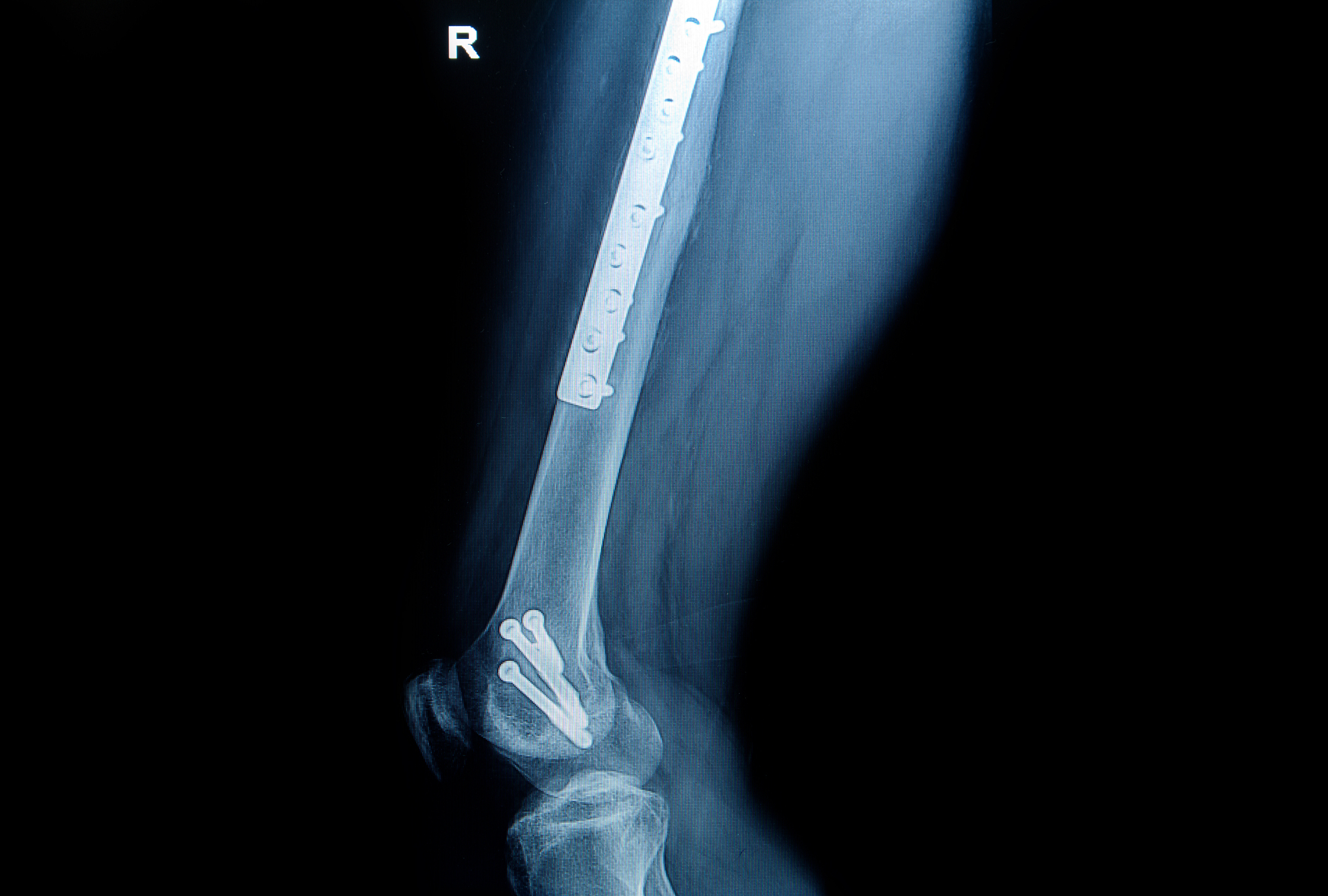 老年股骨粗隆间骨折手术的整体护理模式及重要意义