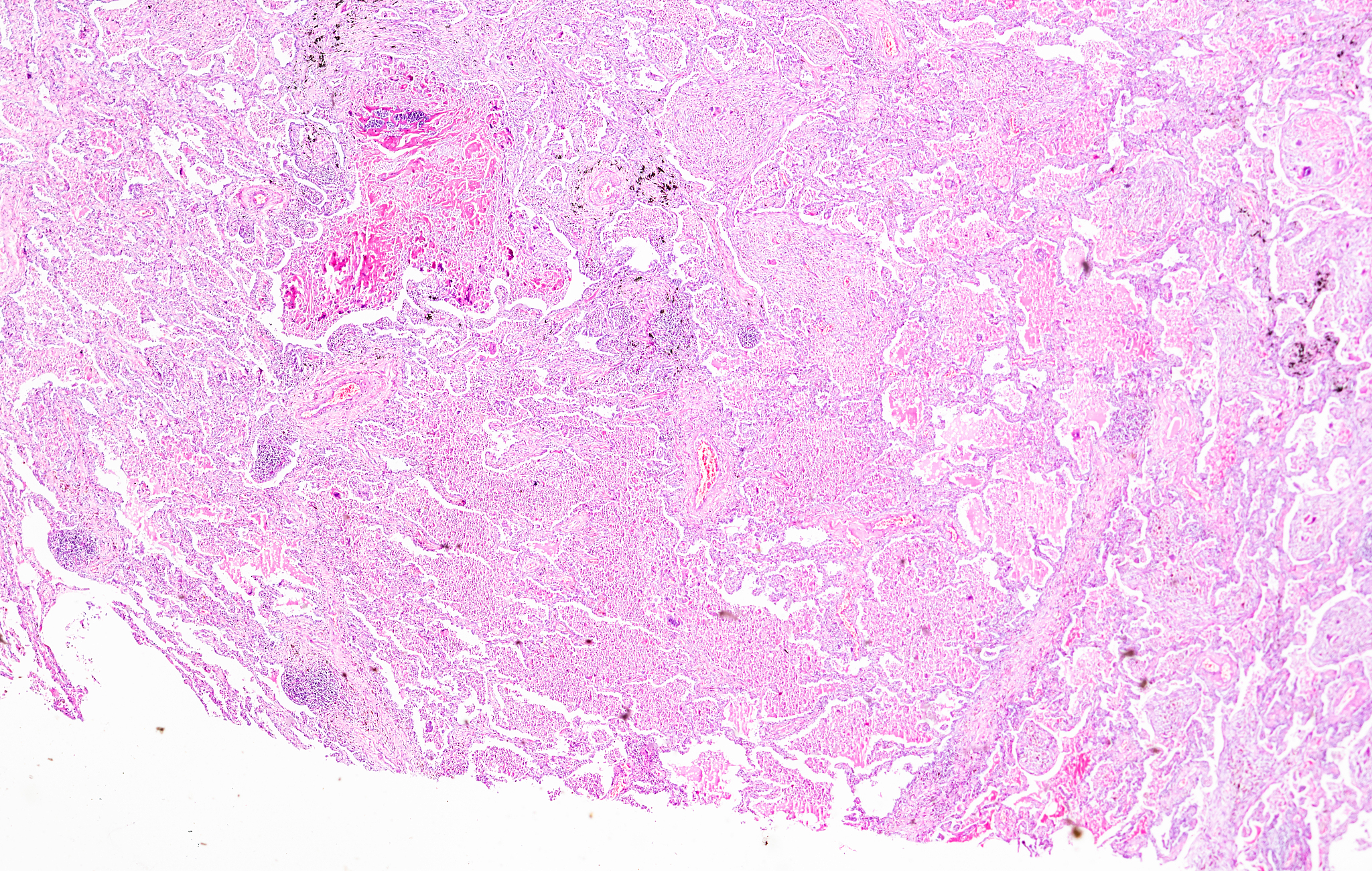翻译：Granulomatous inﬂammation consists of nodular aggregates of epithelioid histiocytes mixed with a polymorphous inﬂammatory inﬁltrate with or without coagulative necrosis In isolation granulomas are
