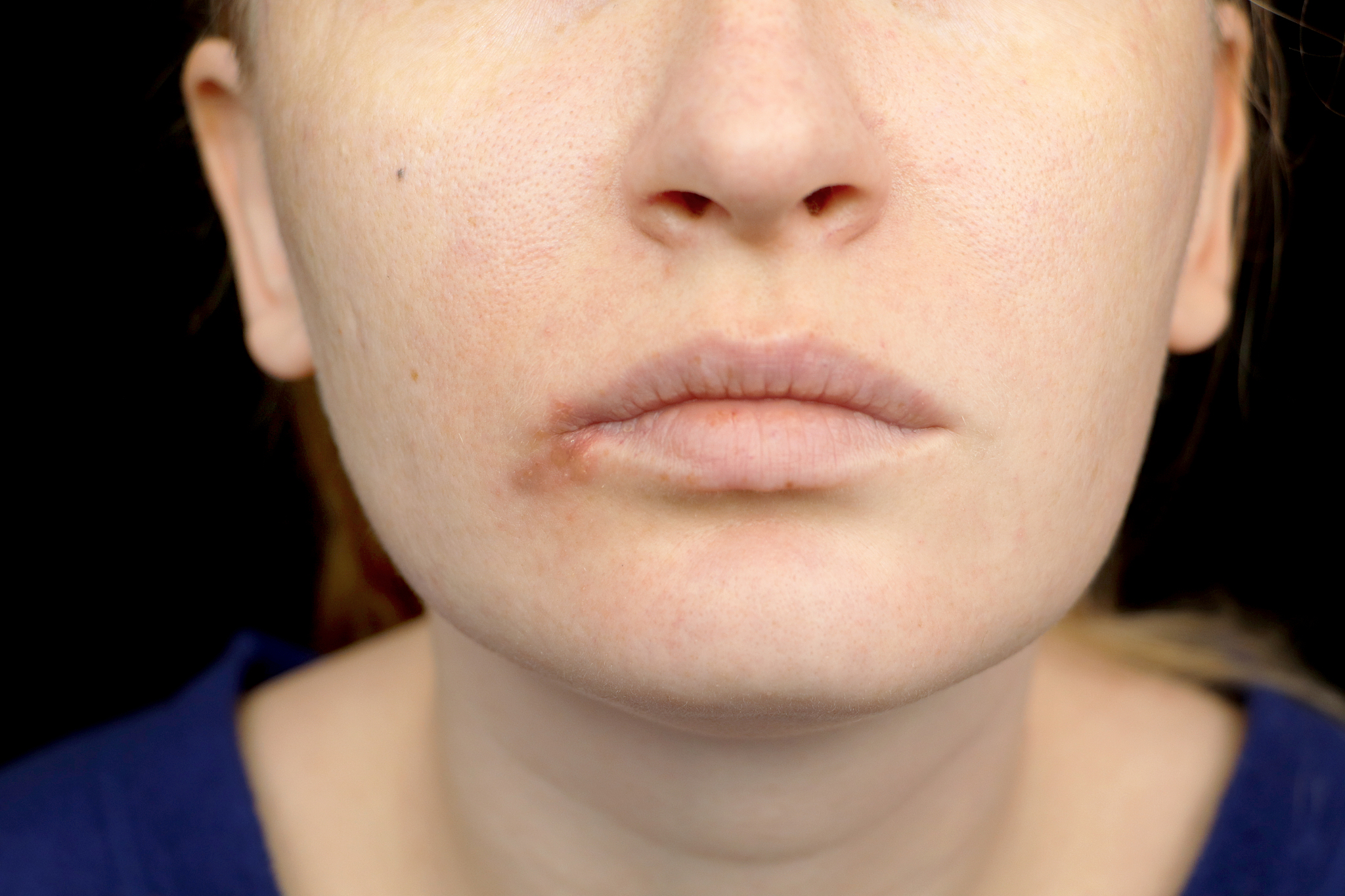 herpes on the lips: a woman with a cold and the herpes virus is 