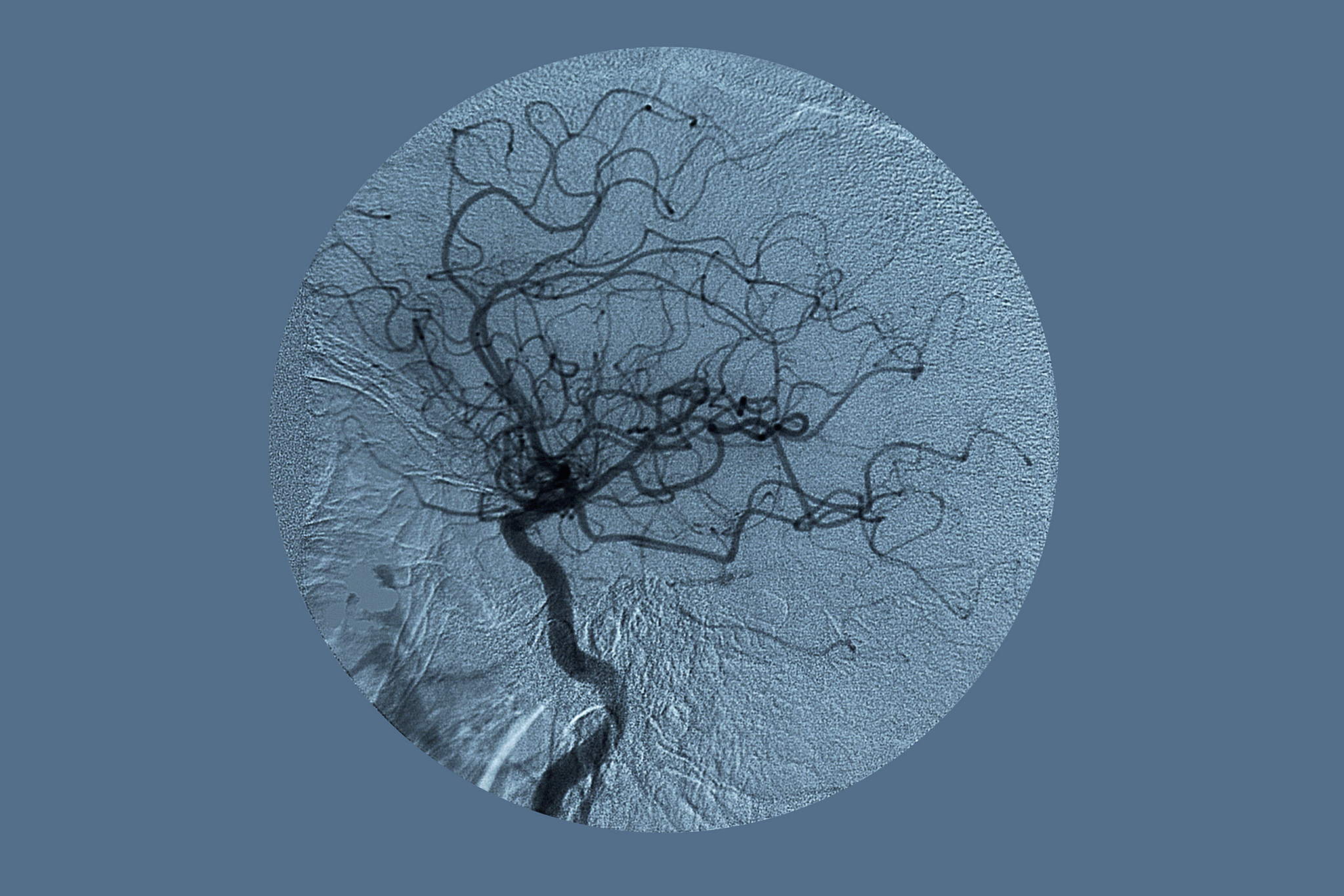 脑出血和单纯疱疹性脑炎：两种不同疾病的危害