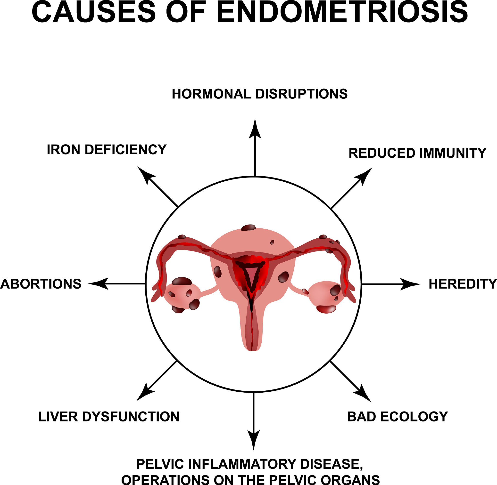 为什么内膜异位会导致疼痛？为什么在月经来潮时疼痛加剧？