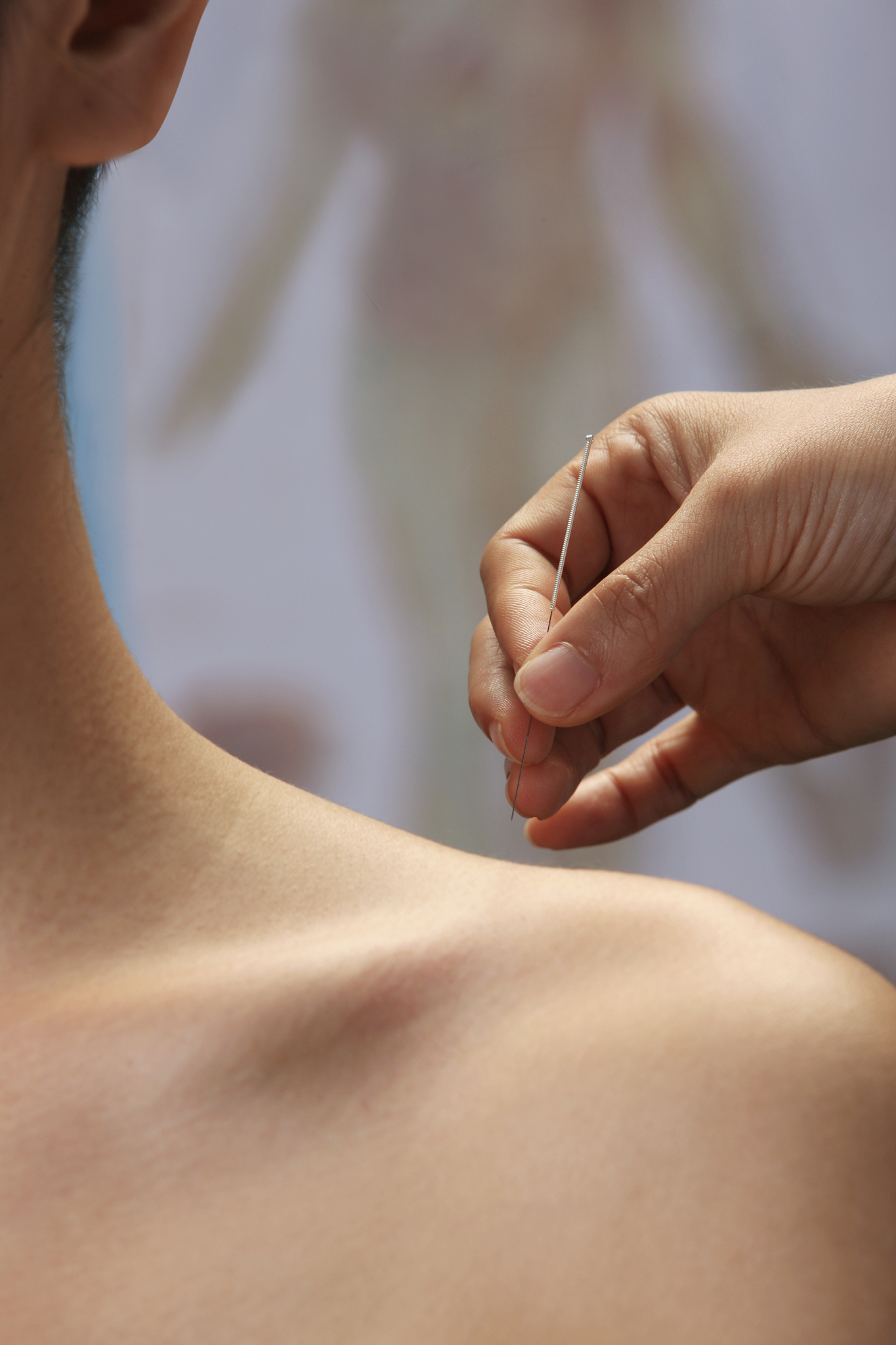 温针灸治疗肩周炎